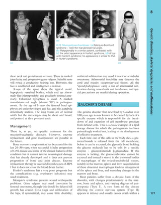 short neck and protuberant sternum. There is marked
joint laxity and progressive genu valgum. Suitable tests
will reveal a conductive hearing loss. However, the
face is unaffected and intelligence is normal.
X-rays of the spine show the typical ovoid,
hypoplastic vertebral bodies, which end up abnor-
mally ﬂat (platyspondyly) and peculiarly pointed ante-
riorly. Odontoid hypoplasia is usual. A marked
manubriosternal angle (almost 90°) is pathogno-
monic. By the age of 5 years the femoral head epi-
physes are underdeveloped and ﬂat, and the acetabula
abnormally shallow. The long bones are of normal
width but the metacarpals may be short and broad,
and pointed at their proximal ends.
Management
There is, as yet, no speciﬁc treatment for the
mucopolysaccharide disorder. However, enzyme
replacement and gene manipulation are possible in
the future.
Bone marrow transplantation has been used for the
last 20–30 years; when successful it halts progression
of CNS disease and some of the clinical features of the
condition but it cannot reverse neurological damage
that has already developed and it does not prevent
progression of bone and joint disease. Enzyme
replacement therapy is successful in mild cases of MPS
I but it does not cross the blood-brain barrier.
Hurler’s syndrome has a very poor prognosis but
the complications (e.g. respiratory infection) may
need treatment.
Morquio’s syndrome presents several orthopaedic
problems. Genu valgum may need correction by
femoral osteotomy, though this should be delayed till
growth has ceased. Coxa valga and subluxation of
the hips, if symmetrical, may cause little disability;
unilateral subluxation may need femoral or acetabular
osteotomy. Atlantoaxial instability may threaten the
cord and require occipitocervical fusion. All the
‘spondylodysplasias’ carry a risk of atlantoaxial sub-
luxation during anaesthesia and intubation, and spe-
cial precautions are needed during operation.
GAUCHER’S DISEASE
The genetic disorder ﬁrst described by Gaucher over
100 years ago is now known to be caused by lack of a
speciﬁc enzyme which is responsible for the break-
down of and excretion of cell membrane products
from defunct cells. This is a classic example of a lipid
storage disease for which the pathogenesis has been
painstakingly worked out, leading to the development
of effective treatment.
Each time one of the cells in the body dies, a glu-
cocerebroside is released from the cell membrane;
before it can be excreted, the glycoside bond holding
the glucose molecule has to be split by a speciﬁc
enzyme – glucosylceramide β-glucosidase. If this
enzyme is lacking, the glucocerebroside cannot be
excreted and instead is stored in the lysosomal bodies
of macrophages of the reticuloendothelial system,
notably in the marrow, spleen and liver. Accumulation
of these abnormal macrophages leads to enlargement
of the spleen and liver, and secondary changes in the
marrow and bone.
Most patients suffer from a chronic form of the
disorder, with changes predominantly in the mar-
row, bone and spleen, and varying degrees of pan-
cytopenia (Type I). A rare form of the disease
affecting the central nervous system (Type II)
appears in infancy and usually causes death within a
Geneticdisorders,skeletaldysplasiasandmalformations
177
8
(a) (d)
8.23 Mucopolysaccharidoses (a) Morquio-Brailsford
syndrome – note the manubriosternal angle.
(b) Platyspondyly in a similar patient, contrasted with
(c) the sabot appearance in Hurler’s syndrome. (d) A boy
with Hunter’s syndrome; his appearance is similar to that
in Hurler’s syndrome.
(b) (c)
 