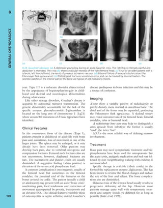year. Type III is a subacute disorder characterized
by the appearance of hepatosplenomegaly in child-
hood and skeletal and neurological abnormalities
during adolescence.
Like other storage disorders, Gaucher’s disease is
acquired by autosomal recessive transmission. The
genetic abnormality accountable for the lack of the
speciﬁc enzyme glucosylceramide b-glucosidase is
located on the long arm of chromosome 1 (1q21)
where around 80 mutations of 3 basic types have been
identiﬁed.
Clinical Features
In the commonest form of the disease (Type I),
patients present in childhood or adult life with bone
pain and, sometimes, loss of movement in one of the
larger joints. The spleen may be enlarged, or it may
already have been removed. Older patients may
develop back pain, due to vertebral osteopenia and
compression fractures. Femoral neck fractures also are
not uncommon; however, diaphyseal fractures are
rare. The haematocrit and platelet count are usually
diminished. A suggestive ﬁnding (when positive) is
elevation of the serum acid phosphatase level.
A common complication is osteonecrosis, usually of
the femoral head but sometimes in the femoral
condyles, the proximal end of the humerus or the
bones around the ankle. The patient (usually a child
or adolescent) may present with an acute ‘bone crisis’:
unrelenting pain, local tenderness and restriction of
movement accompanied by pyrexia, leucocytosis and
an elevated ESR. The clinical features resemble those
of osteomyelitis or septic arthritis; indeed, Gaucher’s
disease predisposes to bone infection and this may be
a source of confusion.
Imaging
X-rays show a variable pattern of radiolucency or
patchy density, more marked in cancellous bone. The
distal end of the femur may be expanded, producing
the Erlenmeyer ﬂask appearance. A skeletal survey
may reveal osteonecrosis of the femoral head, femoral
condyles, talus or humeral head.
A radioisotope bone scan may help to distinguish a
crisis episode from infection: the former is usually
‘cold’, the latter ‘hot’.
MRI is the most reliable way of deﬁning marrow
involvement.
Treatment
Bone pain may need symptomatic treatment and bis-
phosphonates have been used for osteoporosis. For
the acute crisis, analgesic medication and bed rest fol-
lowed by non-weightbearing walking with crutches is
recommended.
Speciﬁc therapy is available (albeit costly) in the
form of the replacement enzyme, alglucerase. This has
been shown to reverse the blood changes and reduce
the size of the liver and spleen. The bone complica-
tions also are diminished.
Osteonecrosis of the femoral head usually results in
progressive deformity of the hip. However most
patients manage quite well with symptomatic treat-
ment and surgery should be deferred for as long as
possible (Katz et al, 1996).
GENERALORTHOPAEDICS
178
8
(a) (c) (d) (e)
(b)
8.24 Gaucher’s disease (a) A distressed young boy during an acute Gaucher crisis. The right hip is intensely painful and
abduction is restricted. The x-ray (b) shows avascular necrosis of the right femoral head. (c) X-ray of an older patient with a
sclerotic left femoral head, the result of previous ischaemic necrosis. (d) Bilateral failure of femoral tubularization (the
Erlenmeyer ﬂask appearance). (e) Pathological fractures sometimes occur and can be treated by internal ﬁxation. The
sclerotic patches in the interior part of the bone are typical of old medullary infarcts.
 