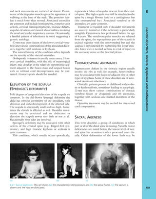 and neck movements are restricted or absent. Promi-
nence of the trapezius muscles gives the appearance of
webbing at the base of the neck. The posterior hair-
line is much lower than normal. Associated anomalies
are common and include hemivertebra, posterior arch
defects, cervical meningomyelocele, thoracic defects,
scapular elevation and visceral abnormalities involving
the renal and cardio-respiratory systems. Occasionally,
a familial pattern of inheritance is noted suggesting a
genetic aetiology.
X-rays may show fusion of the lower cervical verte-
brae and various combinations of the associated disor-
ders, together with scoliosis or kyphosis.
The natural history of the condition often depends
on the severity of the visceral anomalies.
Orthopaedic treatment is usually unnecessary. How-
ever cervical instability, with the risk of neurological
injury, may develop in the relatively hypermobile seg-
ment adjacent to the fusion mass and surgical fusion
with or without cord decompression may be war-
ranted. Contact sports should be avoided.
ELEVATION OF THE SCAPULA
(SPRENGEL’S DEFORMITY)
Mild degrees of congenital elevation of the scapula are
common. In the full-blown Sprengel deformity the
child has obvious asymmetry of the shoulders, with
elevation and underdevelopment of the affected side.
The scapula is abnormally small and too high. Some-
times the clavicle is affected as well. Shoulder move-
ments may be restricted and on abduction or
elevation the scapula moves very little or not at all.
Occasionally both sides are involved.
Sprengel’s deformity may be associated with other
defects of the cervical spine (e.g. Klippel–Feil syn-
drome), and high thoracic kyphosis or scoliosis is
quite common.
This condition, which usually occurs sporadically,
represents a failure of scapular descent from the cervi-
cal spine. The high scapula may still be attached to the
spine by a tough ﬁbrous band or a cartilaginous bar
(the omovertebral bar). Associated vertebral or rib
anomalies are quite common.
Treatment is required only if shoulder movements
are severely limited or if the deformity is particularly
unsightly. Operation is best performed before the age
of 6 years. The vertebroscapular muscles are released
from the spine, the supraspinous part of the scapula is
excised together with the omovertebral bar and the
scapula is repositioned by tightening the lower mus-
cles. Great care is needed as there is a risk of injury to
the accessory nerve or the brachial plexus.
THORACOSPINAL ANOMALIES
Segmentation defects in the thoracic region usually
involve the ribs as well; for example, hemivertebrae
may be associated with fusion of adjacent ribs or other
types of dysplasia. Some of these disorders are of auto-
somal dominant inheritance.
Clinically, patients present in childhood with scolio-
sis or kyphoscoliosis, sometimes leading to paraplegia.
X-rays may show various combinations of thoracic
vertebral fusion or dysgenesis and rib anomalies,
together with scoliosis and marked distortion of the
thorax.
Operative treatment may be needed for threatened
cord compression.
SACRAL AGENESIS
This term describes a group of conditions in which
part or all of the distal spine is missing. Variable motor
deﬁciencies are noted below the lowest level of nor-
mal spine but sensation is often preserved more dis-
tally. Other deformities of the lower limb may be
Geneticdisorders,skeletaldysplasiasandmalformations
181
8
(a) (b) (c)
8.27 Sacral agenesis This girl shows (a) the characteristic sitting posture and (b) the spinal hump. (c) The sacrum is
absent and the hips are dislocated.
 