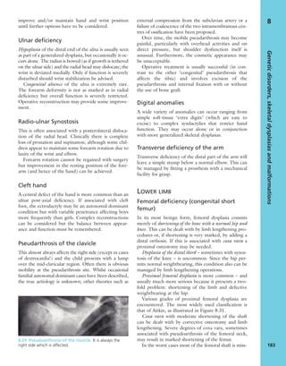 improve and/or maintain hand and wrist position
until further options have to be considered.
Ulnar deficiency
Hypoplasia of the distal end of the ulna is usually seen
as part of a generalized dysplasia, but occasionally it oc-
curs alone. The radius is bowed (as if growth is tethered
on the ulnar side) and the radial head may dislocate; the
wrist is deviated medially. Only if function is severely
disturbed should wrist stabilization be advised.
Congenital absence of the ulna is extremely rare.
The forearm deformity is not as marked as in radial
deﬁciency but overall function is severely restricted.
Operative reconstruction may provide some improve-
ment.
Radio-ulnar Synostosis
This is often associated with a posterolateral disloca-
tion of the radial head. Clinically there is complete
loss of pronation and supination, although some chil-
dren appear to maintain some forearm rotation due to
laxity of the wrist and elbow.
Forearm rotation cannot be regained with surgery
but improvement in the resting position of the fore-
arm (and hence of the hand) can be achieved.
Cleft hand
A central defect of the hand is more common than an
ulnar post-axial deﬁciency. If associated with cleft
foot, the ectrodactyly may be an autosomal dominant
condition but with variable penetrance affecting boys
more frequently than girls. Complex reconstructions
can be considered but the balance between appear-
ance and function must be remembered.
Pseudarthrosis of the clavicle
This almost always affects the right side (except in cases
of dextrocardia!) and the child presents with a lump
over the mid-clavicular region. Often there is obvious
mobility at the pseudarthrosis site. Whilst occasional
familial autosomal dominant cases have been described,
the true aetiology is unknown; other theories such as
external compression from the subclavian artery or a
failure of coalescence of the two intramembranous cen-
tres of ossiﬁcation have been proposed.
Over time, the mobile pseudarthrosis may become
painful, particularly with overhead activities and on
direct pressure, but shoulder dysfunction itself is
unusual. Furthermore, the cosmetic appearance may
be unacceptable.
Operative treatment is usually successful (in con-
trast to the other ‘congenital’ pseudarthrosis that
affects the tibia) and involves excision of the
pseudarthrosis and internal ﬁxation with or without
the use of bone graft.
Digital anomalies
A wide variety of anomalies can occur ranging from
simple soft-tissue ‘extra digits’ (which are easy to
excise) to complex syndactylies that restrict hand
function. They may occur alone or in conjunction
with more generalized skeletal dysplasias.
Transverse deficiency of the arm
Transverse deﬁciency of the distal part of the arm will
leave a simple stump below a normal elbow. This can
be managed by ﬁtting a prosthesis with a mechanical
facility for grasp.
LOWER LIMB
Femoral deficiency (congenital short
femur)
In its most benign form, femoral dysplasia consists
merely of shortening of the bone with a normal hip and
knee. This can be dealt with by limb lengthening pro-
cedures or, if shortening is very marked, by adding a
distal orthosis. If this is associated with coxa vara a
proximal osteotomy may be needed.
Dysplasia of the distal third – sometimes with synos-
tosis of the knee – is uncommon. Since the hip per-
mits normal weightbearing, this condition also can be
managed by limb lengthening operations.
Proximal femoral dysplasia is more common – and
usually much more serious because it presents a two-
fold problem: shortening of the limb and defective
weightbearing at the hip.
Various grades of proximal femoral dysplasia are
encountered. The most widely used classiﬁcation is
that of Aitkin, as illustrated in Figure 8.31.
Coxa vara with moderate shortening of the shaft
can be dealt with by corrective osteotomy and limb
lengthening. Severe degrees of coxa vara, sometimes
associated with pseudoarthrosis of the femoral neck,
may result in marked shortening of the femur.
In the worst cases most of the femoral shaft is miss-
Geneticdisorders,skeletaldysplasiasandmalformations
183
8
8.29 Pseudoarthrosis of the clavicle It is always the
right side which is affected.
 