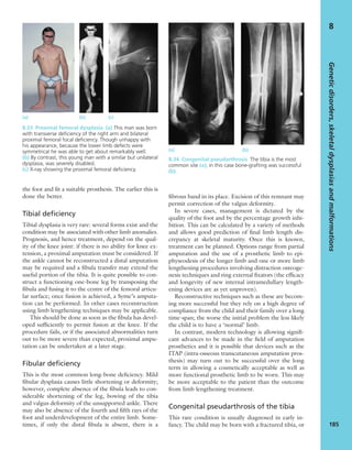 the foot and ﬁt a suitable prosthesis. The earlier this is
done the better.
Tibial deficiency
Tibial dysplasia is very rare: several forms exist and the
condition may be associated with other limb anomalies.
Prognosis, and hence treatment, depend on the qual-
ity of the knee joint: if there is no ability for knee ex-
tension, a proximal amputation must be considered. If
the ankle cannot be reconstructed a distal amputation
may be required and a ﬁbula transfer may extend the
useful portion of the tibia. It is quite possible to con-
struct a functioning one-bone leg by transposing the
ﬁbula and fusing it to the centre of the femoral articu-
lar surface; once fusion is achieved, a Syme’s amputa-
tion can be performed. In other cases reconstruction
using limb lengthening techniques may be applicable.
This should be done as soon as the ﬁbula has devel-
oped sufﬁciently to permit fusion at the knee. If the
procedure fails, or if the associated abnormalities turn
out to be more severe than expected, proximal ampu-
tation can be undertaken at a later stage.
Fibular deficiency
This is the most common long-bone deﬁciency. Mild
ﬁbular dysplasia causes little shortening or deformity;
however, complete absence of the ﬁbula leads to con-
siderable shortening of the leg, bowing of the tibia
and valgus deformity of the unsupported ankle. There
may also be absence of the fourth and ﬁfth rays of the
foot and underdevelopment of the entire limb. Some-
times, if only the distal ﬁbula is absent, there is a
ﬁbrous band in its place. Excision of this remnant may
permit correction of the valgus deformity.
In severe cases, management is dictated by the
quality of the foot and by the percentage growth inhi-
bition. This can be calculated by a variety of methods
and allows good prediction of ﬁnal limb length dis-
crepancy at skeletal maturity. Once this is known,
treatment can be planned. Options range from partial
amputation and the use of a prosthetic limb to epi-
physeodesis of the longer limb and one or more limb
lengthening procedures involving distraction osteoge-
nesis techniques and ring external ﬁxators (the efﬁcacy
and longevity of new internal intramedullary length-
ening devices are as yet unproven).
Reconstructive techniques such as these are becom-
ing more successful but they rely on a high degree of
compliance from the child and their family over a long
time-span; the worse the initial problem the less likely
the child is to have a ‘normal’ limb.
In contrast, modern technology is allowing signiﬁ-
cant advances to be made in the ﬁeld of amputation
prosthetics and it is possible that devices such as the
ITAP (intra-osseous transcutaneous amputation pros-
thesis) may turn out to be successful over the long
term in allowing a cosmetically acceptable as well as
more functional prosthetic limb to be worn. This may
be more acceptable to the patient than the outcome
from limb lengthening treatment.
Congenital pseudarthrosis of the tibia
This rare condition is usually diagnosed in early in-
fancy. The child may be born with a fractured tibia, or
Geneticdisorders,skeletaldysplasiasandmalformations
185
8
(a) (b) (c)
8.33 Proximal femoral dysplasia (a) This man was born
with transverse deﬁciency of the right arm and bilateral
proximal femoral focal deﬁciency. Though unhappy with
his appearance, because the lower limb defects were
symmetrical he was able to get about remarkably well.
(b) By contrast, this young man with a similar but unilateral
dysplasia, was severely disabled.
(c) X-ray showing the proximal femoral deﬁciency.
(a) (b)
8.34 Congenital pseudarthrosis The tibia is the most
common site (a); in this case bone-grafting was successful
(b).
 