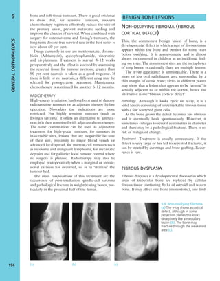 bone and soft-tissue tumours. There is good evidence
to show that, for sensitive tumours, modern
chemotherapy regimens effectively reduce the size of
the primary lesion, prevent metastatic seeding and
improve the chances of survival. When combined with
surgery for osteosarcoma and Ewing’s tumours, the
long-term disease-free survival rate in the best series is
now about 60 per cent.
Drugs currently in use are methotrexate, doxoru-
bicin (Adriamycin), cyclophosphamide, vincristine
and cis-platinum. Treatment is started 8–12 weeks
preoperatively and the effect is assessed by examining
the resected tissue for tumour necrosis; greater than
90 per cent necrosis is taken as a good response. If
there is little or no necrosis, a different drug may be
selected for postoperative treatment. Maintenance
chemotherapy is continued for another 6–12 months.
RADIOTHERAPY
High-energy irradiation has long been used to destroy
radiosensitive tumours or as adjuvant therapy before
operation. Nowadays the indications are more
restricted. For highly sensitive tumours (such as
Ewing’s sarcoma) it offers an alternative to amputa-
tion; it is then combined with adjuvant chemotherapy.
The same combination can be used as adjunctive
treatment for high-grade tumours, for tumours in
inaccessible sites, lesions that are inoperable because
of their size, proximity to major blood vessels or
advanced local spread, for marrow-cell tumours such
as myeloma and malignant lymphoma, for metastatic
deposits and for palliative local tumour control where
no surgery is planned. Radiotherapy may also be
employed postoperatively when a marginal or intrale-
sional excision has occurred, so as to ‘sterilize’ the
tumour bed.
The main complications of this treatment are the
occurrence of post-irradiation spindle-cell sarcoma
and pathological fracture in weightbearing bones, par-
ticularly in the proximal half of the femur.
BENIGN BONE LESIONS
NON-OSSIFYING FIBROMA (FIBROUS
CORTICAL DEFECT)
This, the commonest benign lesion of bone, is a
developmental defect in which a nest of ﬁbrous tissue
appears within the bone and persists for some years
before ossifying. It is asymptomatic and is almost
always encountered in children as an incidental ﬁnd-
ing on x-ray. The commonest sites are the metaphyses
of long bones; occasionally there are multiple lesions.
The x-ray appearance is unmistakable. There is a
more or less oval radiolucent area surrounded by a
thin margin of dense bone; views in different planes
may show that a lesion that appears to be ‘central’ is
actually adjacent to or within the cortex, hence the
alternative name ‘ﬁbrous cortical defect’.
Pathology Although it looks cystic on x-ray, it is a
solid lesion consisting of unremarkable ﬁbrous tissue
with a few scattered giant cells.
As the bone grows the defect becomes less obvious
and it eventually heals spontaneously. However, it
sometimes enlarges to several centimetres in diameter
and there may be a pathological fracture. There is no
risk of malignant change.
Treatment Treatment is usually unnecessary. If the
defect is very large or has led to repeated fractures, it
can be treated by curettage and bone grafting. Recur-
rence is rare.
FIBROUS DYSPLASIA
Fibrous dysplasia is a developmental disorder in which
areas of trabecular bone are replaced by cellular
ﬁbrous tissue containing ﬂecks of osteoid and woven
bone. It may affect one bone (monostotic), one limb
GENERALORTHOPAEDICS
194
9
(a) (b) (c)
9.4 Non-ossifying ﬁbroma
(a) The x-ray shows a cortical
defect, although in some
projection planes this looks
deceptively like a medullary
lesion (b). The bone may
fracture through the weakened
area (c).
 