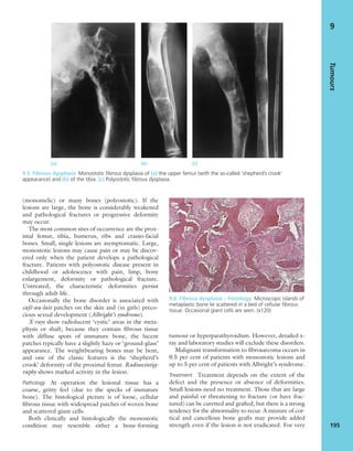 (monomelic) or many bones (polyostotic). If the
lesions are large, the bone is considerably weakened
and pathological fractures or progressive deformity
may occur.
The most common sites of occurrence are the prox-
imal femur, tibia, humerus, ribs and cranio-facial
bones. Small, single lesions are asymptomatic. Large,
monostotic lesions may cause pain or may be discov-
ered only when the patient develops a pathological
fracture. Patients with polyostotic disease present in
childhood or adolescence with pain, limp, bony
enlargement, deformity or pathological fracture.
Untreated, the characteristic deformities persist
through adult life.
Occasionally the bone disorder is associated with
café-au-lait patches on the skin and (in girls) preco-
cious sexual development (Albright’s syndrome).
X-rays show radiolucent ‘cystic’ areas in the meta-
physis or shaft; because they contain ﬁbrous tissue
with diffuse spots of immature bone, the lucent
patches typically have a slightly hazy or ‘ground-glass’
appearance. The weightbearing bones may be bent,
and one of the classic features is the ‘shepherd’s
crook’ deformity of the proximal femur. Radioscintig-
raphy shows marked activity in the lesion.
Pathology At operation the lesional tissue has a
coarse, gritty feel (due to the specks of immature
bone). The histological picture is of loose, cellular
ﬁbrous tissue with widespread patches of woven bone
and scattered giant cells.
Both clinically and histologically the monostotic
condition may resemble either a bone-forming
tumour or hyperparathyroidism. However, detailed x-
ray and laboratory studies will exclude these disorders.
Malignant transformation to ﬁbrosarcoma occurs in
0.5 per cent of patients with monostotic lesions and
up to 5 per cent of patients with Albright’s syndrome.
Treatment Treatment depends on the extent of the
defect and the presence or absence of deformities.
Small lesions need no treatment. Those that are large
and painful or threatening to fracture (or have frac-
tured) can be curetted and grafted, but there is a strong
tendency for the abnormality to recur. A mixture of cor-
tical and cancellous bone grafts may provide added
strength even if the lesion is not eradicated. For very
Tumours
195
9
(a) (b) (c)
9.5 Fibrous dysplasia Monostotic ﬁbrous dysplasia of (a) the upper femur (with the so-called ‘shepherd’s crook’
appearance) and (b) of the tibia. (c) Polyostotic ﬁbrous dysplasia.
9.6 Fibrous dysplasia – histology Microscopic islands of
metaplastic bone lie scattered in a bed of cellular ﬁbrous
tissue. Occasional giant cells are seen. (x120)
 