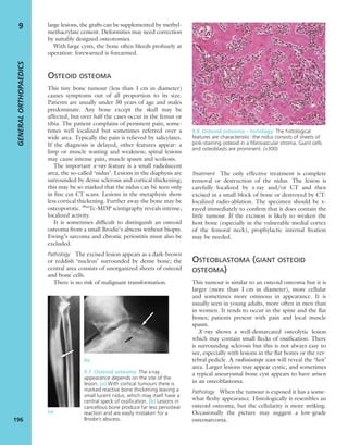 large lesions, the grafts can be supplemented by methyl-
methacrylate cement. Deformities may need correction
by suitably designed osteotomies.
With large cysts, the bone often bleeds profusely at
operation: forewarned is forearmed.
OSTEOID OSTEOMA
This tiny bone tumour (less than 1 cm in diameter)
causes symptoms out of all proportion to its size.
Patients are usually under 30 years of age and males
predominate. Any bone except the skull may be
affected, but over half the cases occur in the femur or
tibia. The patient complains of persistent pain, some-
times well localized but sometimes referred over a
wide area. Typically the pain is relieved by salicylates.
If the diagnosis is delayed, other features appear: a
limp or muscle wasting and weakness; spinal lesions
may cause intense pain, muscle spasm and scoliosis.
The important x-ray feature is a small radiolucent
area, the so-called ‘nidus’. Lesions in the diaphysis are
surrounded by dense sclerosis and cortical thickening;
this may be so marked that the nidus can be seen only
in ﬁne cut CT scans. Lesions in the metaphysis show
less cortical thickening. Further away the bone may be
osteoporotic. 99m
Tc-MDP scintigraphy reveals intense,
localized activity.
It is sometimes difﬁcult to distinguish an osteoid
osteoma from a small Brodie’s abscess without biopsy.
Ewing’s sarcoma and chronic periostitis must also be
excluded.
Pathology The excised lesion appears as a dark-brown
or reddish ‘nucleus’ surrounded by dense bone; the
central area consists of unorganized sheets of osteoid
and bone cells.
There is no risk of malignant transformation.
Treatment The only effective treatment is complete
removal or destruction of the nidus. The lesion is
carefully localized by x-ray and/or CT and then
excised in a small block of bone or destroyed by CT-
localized radio-ablation. The specimen should be x-
rayed immediately to conﬁrm that it does contain the
little tumour. If the excision is likely to weaken the
host bone (especially in the vulnerable medial cortex
of the femoral neck), prophylactic internal ﬁxation
may be needed.
OSTEOBLASTOMA (GIANT OSTEOID
OSTEOMA)
This tumour is similar to an osteoid osteoma but it is
larger (more than 1 cm in diameter), more cellular
and sometimes more ominous in appearance. It is
usually seen in young adults, more often in men than
in women. It tends to occur in the spine and the ﬂat
bones; patients present with pain and local muscle
spasm.
X-ray shows a well-demarcated osteolytic lesion
which may contain small ﬂecks of ossiﬁcation. There
is surrounding sclerosis but this is not always easy to
see, especially with lesions in the ﬂat bones or the ver-
tebral pedicle. A radioisotope scan will reveal the ‘hot’
area. Larger lesions may appear cystic, and sometimes
a typical aneurysmal bone cyst appears to have arisen
in an osteoblastoma.
Pathology When the tumour is exposed it has a some-
what ﬂeshy appearance. Histologically it resembles an
osteoid osteoma, but the cellularity is more striking.
Occasionally the picture may suggest a low-grade
osteosarcoma.
GENERALORTHOPAEDICS
196
9
(a)
(b)
9.7 Osteoid osteoma The x-ray
appearance depends on the site of the
lesion. (a) With cortical tumours there is
marked reactive bone thickening leaving a
small lucent nidus, which may itself have a
central speck of ossiﬁcation. (b) Lesions in
cancellous bone produce far less periosteal
reaction and are easily mistaken for a
Brodie’s abscess.
9.8 Osteoid osteoma – histology The histological
features are characteristic: the nidus consists of sheets of
pink-staining osteoid in a ﬁbrovascular stroma. Giant cells
and osteoblasts are prominent. (×300)
 