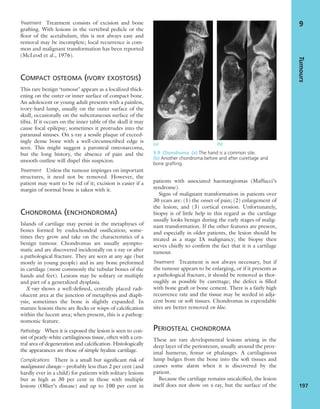 Treatment Treatment consists of excision and bone
grafting. With lesions in the vertebral pedicle or the
ﬂoor of the acetabulum, this is not always easy and
removal may be incomplete; local recurrence is com-
mon and malignant transformation has been reported
(McLeod et al., 1976).
COMPACT OSTEOMA (IVORY EXOSTOSIS)
This rare benign ‘tumour’ appears as a localized thick-
ening on the outer or inner surface of compact bone.
An adolescent or young adult presents with a painless,
ivory-hard lump, usually on the outer surface of the
skull, occasionally on the subcutaneous surface of the
tibia. If it occurs on the inner table of the skull it may
cause focal epilepsy; sometimes it protrudes into the
paranasal sinuses. On x-ray a sessile plaque of exceed-
ingly dense bone with a well-circumscribed edge is
seen. This might suggest a parosteal osteosarcoma,
but the long history, the absence of pain and the
smooth outline will dispel this suspicion.
Treatment Unless the tumour impinges on important
structures, it need not be removed. However, the
patient may want to be rid of it; excision is easier if a
margin of normal bone is taken with it.
CHONDROMA (ENCHONDROMA)
Islands of cartilage may persist in the metaphyses of
bones formed by endochondral ossiﬁcation; some-
times they grow and take on the characteristics of a
benign tumour. Chondromas are usually asympto-
matic and are discovered incidentally on x-ray or after
a pathological fracture. They are seen at any age (but
mostly in young people) and in any bone preformed
in cartilage (most commonly the tubular bones of the
hands and feet). Lesions may be solitary or multiple
and part of a generalized dysplasia.
X-ray shows a well-deﬁned, centrally placed radi-
olucent area at the junction of metaphysis and diaph-
ysis; sometimes the bone is slightly expanded. In
mature lesions there are ﬂecks or wisps of calciﬁcation
within the lucent area; when present, this is a pathog-
nomonic feature.
Pathology When it is exposed the lesion is seen to con-
sist of pearly-white cartilaginous tissue, often with a cen-
tral area of degeneration and calciﬁcation. Histologically
the appearances are those of simple hyaline cartilage.
Complications There is a small but signiﬁcant risk of
malignant change – probably less than 2 per cent (and
hardly ever in a child) for patients with solitary lesions
but as high as 30 per cent in those with multiple
lesions (Ollier’s disease) and up to 100 per cent in
patients with associated haemangiomas (Maffucci’s
syndrome).
Signs of malignant transformation in patients over
30 years are: (1) the onset of pain; (2) enlargement of
the lesion; and (3) cortical erosion. Unfortunately,
biopsy is of little help in this regard as the cartilage
usually looks benign during the early stages of malig-
nant transformation. If the other features are present,
and especially in older patients, the lesion should be
treated as a stage IA malignancy; the biopsy then
serves chieﬂy to conﬁrm the fact that it is a cartilage
tumour.
Treatment Treatment is not always necessary, but if
the tumour appears to be enlarging, or if it presents as
a pathological fracture, it should be removed as thor-
oughly as possible by curettage; the defect is ﬁlled
with bone graft or bone cement. There is a fairly high
recurrence rate and the tissue may be seeded in adja-
cent bone or soft tissues. Chondromas in expendable
sites are better removed en bloc.
PERIOSTEAL CHONDROMA
These are rare developmental lesions arising in the
deep layer of the periosteum, usually around the prox-
imal humerus, femur or phalanges. A cartilaginous
lump bulges from the bone into the soft tissues and
causes some alarm when it is discovered by the
patient.
Because the cartilage remains uncalciﬁed, the lesion
itself does not show on x-ray, but the surface of the
Tumours
197
9
(a) (b)
9.9 Chondroma (a) The hand is a common site.
(b) Another chondroma before and after curettage and
bone grafting.
 