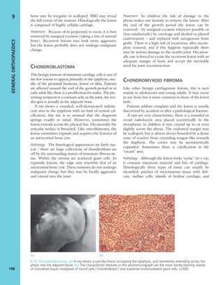 bone may be irregular or scalloped. MRI may reveal
the full extent of the tumour. Histologically the lesion
is composed of highly cellular cartilage.
Treatment Because of its propensity to recur, it is best
removed by marginal excision (taking a rim of normal
bone). Recurrent lesions may look more aggressive
but the lesion probably does not undergo malignant
change.
CHONDROBLASTOMA
This benign tumour of immature cartilage cells is one of
the few lesions to appear primarily in the epiphysis, usu-
ally of the proximal humerus, femur or tibia. Patients
are affected around the end of the growth period or in
early adult life; there is a predilection for males. The pre-
senting symptom is a constant ache in the joint; the ten-
der spot is actually in the adjacent bone.
X-ray shows a rounded, well-demarcated radiolu-
cent area in the epiphysis with no hint of central cal-
ciﬁcation; this site is so unusual that the diagnosis
springs readily to mind. However, sometimes the
lesion extends across the physeal line. Occasionally the
articular surface is breached. Like osteoblastoma, the
lesion sometimes expands and acquires the features of
an aneurysmal bone cyst.
Pathology The histological appearances are fairly typ-
ical – there are large collections of chondroblasts set
off by the surrounding matrix of immature ﬁbrous tis-
sue. Within the stroma are scattered giant cells. In
expansile lesions, the edge may resemble that of an
aneurysmal bone cyst. These tumours do not undergo
malignant change but they may be locally aggressive
and extend into the joint.
Treatment In children the risk of damage to the
physis makes one hesitate to remove the lesion. After
the end of the growth period the lesion can be
removed – by marginal excision wherever possible or
(less satisfactorily) by curettage and alcohol or phenol
cauterization – and replaced with autogenous bone
grafts. There is a high risk of recurrence after incom-
plete removal, and if this happens repeatedly there
may be serious damage to the nearby joint. Occasion-
ally one is forced to excise the recurrent lesion with an
adequate margin of bone and accept the inevitable
need for joint reconstruction.
CHONDROMYXOID FIBROMA
Like other benign cartilaginous lesions, this is seen
mainly in adolescents and young adults. It may occur
in any bone but is more common in those of the lower
limb.
Patients seldom complain and the lesion is usually
discovered by accident or after a pathological fracture.
X-rays are very characteristic: there is a rounded or
ovoid radiolucent area placed eccentrically in the
metaphysis; in children it may extend up to or even
slightly across the physis. The endosteal margin may
be scalloped, but is almost always bounded by a dense
zone of reactive bone extending tongue-like towards
the diaphysis. The cortex may be asymmetrically
expanded. Sometimes there is calciﬁcation in the
‘vacant’ area.
Pathology Although the lesion looks ‘cystic’ on x-ray,
it contains mucinous material and bits of cartilage.
Histologically three types of tissue can usually be
identiﬁed: patches of myxomatous tissue with deli-
cate, stellate cells; islands of hyaline cartilage; and
GENERALORTHOPAEDICS
198
9
9.10 Chondroblastoma (a) X-ray shows a cyst-like lesion occupying the epiphysis, and sometimes extending across the
physis into the adjacent bone. (b) The characteristic features in this photomicrograph are the more faintly staining islands
of chondroid tissue composed of round cells (‘chondroblasts’) and scattered multinucleated giant cells. (×300)
(a) (b)
 