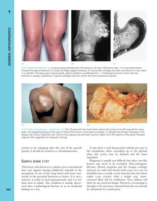 certain to be enlarging after the end of the growth
period, it should be treated as a chondrosarcoma.
SIMPLE BONE CYST
This lesion (also known as a solitary cyst or unicameral
bone cyst) appears during childhood, typically in the
metaphysis of one of the long bones and most com-
monly in the proximal humerus or femur. It is not a
tumour, it tends to heal spontaneously and it is sel-
dom seen in adults. The condition is usually discov-
ered after a pathological fracture or as an incidental
ﬁnding on x-ray.
X-rays show a well-demarcated radiolucent area in
the metaphysis, often extending up to the physeal
plate; the cortex may be thinned and the bone
expanded.
Diagnosis is usually not difﬁcult but other cyst-like
lesions may need to be excluded. Non-osteogenic
ﬁbroma, ﬁbrous dysplasia and the benign cartilage
tumours are solid and merely look cystic on x-ray. In
doubtful cases a needle can be inserted into the lesion
under x-ray control: with a simple cyst, straw-
coloured ﬂuid will be withdrawn. Very seldom will
there be any need for biopsy. However, if curettage is
thought to be necessary, material from the cyst should
be submitted for examination.
GENERALORTHOPAEDICS
200
9
9.12 Osteochondroma (a) A young girl presented with this lump on her leg. It felt bony hard. (b) X-ray examination
showed the typical features of a large cartilage-capped exostosis; of course the cartilage cap does not show on x-ray unless
it is calciﬁed. The bony part may be sessile, pedunculated or cauliﬂower-like. (c) Histological sections show that the
exostosis is always covered by a hyaline cartilage cap from which the bony excrescence grows.
(a) (b) (c)
(a) (b)
9.13 Osteochondroma – treatment (a) This 20-year-old man had known about the lump on his left scapula for many
years. He stopped growing at the age of 18 but the tumour continued to enlarge. (b) Despite the benign histology in the
biopsy, the tumour together with most of the scapula was removed; sections taken from the depths of the lesion showed
atypical cells suggestive of malignant change.
 