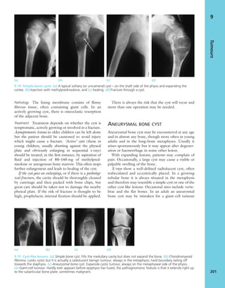Pathology The lining membrane consists of ﬂimsy
ﬁbrous tissue, often containing giant cells. In an
actively growing cyst, there is osteoclastic resorption
of the adjacent bone.
Treatment Treatment depends on whether the cyst is
symptomatic, actively growing or involved in a fracture.
Asymptomatic lesions in older children can be left alone
but the patient should be cautioned to avoid injury
which might cause a fracture. ‘Active’ cysts (those in
young children, usually abutting against the physeal
plate and obviously enlarging in sequential x-rays)
should be treated, in the ﬁrst instance, by aspiration of
ﬂuid and injection of 80–160 mg of methylpred-
nisolone or autogenous bone marrow. This often stops
further enlargement and leads to healing of the cyst.
If the cyst goes on enlarging, or if there is a patholog-
ical fracture, the cavity should be thoroughly cleaned
by curettage and then packed with bone chips, but
great care should be taken not to damage the nearby
physeal plate. If the risk of fracture is thought to be
high, prophylactic internal ﬁxation should be applied.
There is always the risk that the cyst will recur and
more than one operation may be needed.
ANEURYSMAL BONE CYST
Aneurysmal bone cyst may be encountered at any age
and in almost any bone, though more often in young
adults and in the long-bone metaphyses. Usually it
arises spontaneously but it may appear after degener-
ation or haemorrhage in some other lesion.
With expanding lesions, patients may complain of
pain. Occasionally, a large cyst may cause a visible or
palpable swelling of the bone.
X-rays show a well-deﬁned radiolucent cyst, often
trabeculated and eccentrically placed. In a growing
tubular bone it is always situated in the metaphysis
and therefore may resemble a simple cyst or one of the
other cyst-like lesions. Occasional sites include verte-
brae and the ﬂat bones. In an adult an aneurysmal
bone cyst may be mistaken for a giant-cell tumour
Tumours
201
9
(a) (b) (c) (d)
9.14 Simple bone cysts (a) A typical solitary (or unicameral) cyst – on the shaft side of the physis and expanding the
cortex. (b) Injection with methylprednisolone, and (c) healing. (d) Fracture through a cyst.
9.15 Cyst-like lesions (a) Simple bone cyst. Fills the medullary cavity but does not expand the bone. (b) Chondromyxoid
ﬁbroma. Looks cystic but it is actually a radiolucent benign tumour; always in the metaphysis; hard boundary tailing off
towards the diaphysis. (c) Aneurysmal bone cyst. Expansile cystic tumour, always on the metaphyseal side of the physis.
(d) Giant-cell tumour. Hardly ever appears before epiphysis has fused, the pathognomonic feature is that it extends right up
to the subarticular bone plate; sometimes malignant.
(a) (b) (c) (d)
 