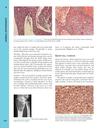 but, unlike the latter, it usually does not extend right
up to the articular margin. Occasionally it causes
marked ballooning of the bone end.
Pathology When the cyst is opened it is found to con-
tain clotted blood, and during curettage there may be
considerable bleeding from the ﬂeshy lining mem-
brane. Histologically the lining consists of ﬁbrous tis-
sue with vascular spaces, deposits of haemosiderin and
multinucleated giant cells. Occasionally the appear-
ances so closely resemble those of giant-cell tumour
that only the most experienced pathologists can con-
ﬁdently make the diagnosis. Malignant transformation
does not occur.
Treatment The cyst should be carefully opened, thor-
oughly curetted and then packed with bone grafts.
Sometimes the graft is resorbed and the cyst recurs,
necessitating a second or third operation. In these
cases, packing with methylmethacrylate cement may
be more effective. However, if the cyst is in a ‘safe’
area (i.e. where there is no risk of fracture) there is no
hurry to re-operate; the lesion occasionally heals
spontaneously (Malghem et al., 1989).
GIANT-CELL TUMOUR
Giant-cell tumour, which represents 5 per cent of all
primary bone tumours, is a lesion of uncertain origin
that appears in mature bone, most commonly in the
distal femur, proximal tibia, proximal humerus and
distal radius, though other bones also may be
affected. It is hardly ever seen before closure of the
nearby physis and characteristically it extends right up
to the subarticular bone plate. Rarely, there are multi-
ple lesions.
The patient is usually a young adult who complains
of pain at the end of a long bone; sometimes there is
slight swelling. A history of trauma is not uncommon
GENERALORTHOPAEDICS
202
9
(a) (b)
9.16 Aneurysmal bone cyst – histology (a) The cyst contained blood and was lined by loose ﬁbrous tissue containing
numerous giant cells. (×120) (b) A high-power view of the same. (×300)
9.18 Giant-cell tumour – histology A low-power view
of the biopsy shows the abundant multinucleated giant
cells lying in a stroma composed of round and polyhedral
tumour cells. There are numerous mitotic ﬁgures.
9.17 Giant-cell tumours The tumour always abuts
against the joint margin.
 