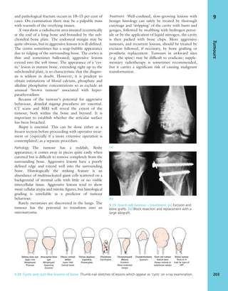 and pathological fracture occurs in 10–15 per cent of
cases. On examination there may be a palpable mass
with warmth of the overlying tissues.
X-rays show a radiolucent area situated eccentrically
at the end of a long bone and bounded by the sub-
chondral bone plate. The endosteal margin may be
quite obvious, but in aggressive lesions it is ill-deﬁned.
The centre sometimes has a soap-bubble appearance
due to ridging of the surrounding bone. The cortex is
thin and sometimes ballooned; aggressive lesions
extend into the soft tissue. The appearance of a ‘cys-
tic’ lesion in mature bone, extending right up to the
subchondral plate, is so characteristic that the diagno-
sis is seldom in doubt. However, it is prudent to
obtain estimations of blood calcium, phosphate and
alkaline phosphatise concentrations so as exclude an
unusual ‘brown tumour’ associated with hyper-
parathyroidism.
Because of the tumour’s potential for aggressive
behaviour, detailed staging procedures are essential.
CT scans and MRI will reveal the extent of the
tumour, both within the bone and beyond. It is
important to establish whether the articular surface
has been breached.
Biopsy is essential. This can be done either as a
frozen section before proceeding with operative treat-
ment or (especially if a more extensive operation is
contemplated) as a separate procedure.
Pathology The tumour has a reddish, ﬂeshy
appearance; it comes away in pieces quite easily when
curetted but is difﬁcult to remove completely from the
surrounding bone. Aggressive lesions have a poorly
deﬁned edge and extend well into the surrounding
bone. Histologically the striking feature is an
abundance of multinucleated giant cells scattered on a
background of stromal cells with little or no visible
intercellular tissue. Aggressive lesions tend to show
more cellular atypia and mitotic ﬁgures, but histological
grading is unreliable as a predictor of tumour
behaviour.
Rarely metastases are discovered in the lungs. The
tumour has the potential to transform into an
osteosarcoma.
Treatment Well-conﬁned, slow-growing lesions with
benign histology can safely be treated by thorough
curettage and ‘stripping’ of the cavity with burrs and
gouges, followed by swabbing with hydrogen perox-
ide or by the application of liquid nitrogen; the cavity
is then packed with bone chips. More aggressive
tumours, and recurrent lesions, should be treated by
excision followed, if necessary, by bone grafting or
prosthetic replacement. Tumours in awkward sites
(e.g. the spine) may be difﬁcult to eradicate; supple-
mentary radiotherapy is sometimes recommended,
but it carries a signiﬁcant risk of causing malignant
transformation.
Tumours
203
9
9.19 Giant-cell tumour – treatment (a) Excision and
bone grafts. (b) Block resection and replacement with a
large allograft.
(b)
(a)
9.20 Cysts and cyst-like lesions of bone Thumb-nail sketches of lesions which appear as ‘cysts’ on x-ray examination.
 