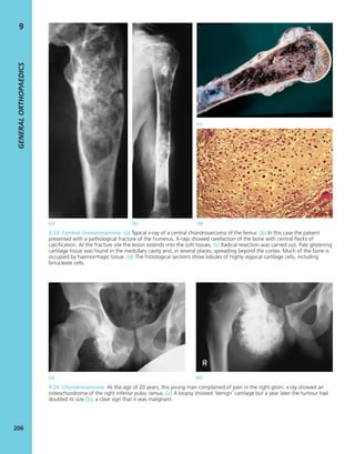 GENERALORTHOPAEDICS
206
9
(a) (b) (d)
(c)
9.23 Central chondrosaroma (a) Typical x-ray of a central chondrosarcoma of the femur. (b) In this case the patient
presented with a pathological fracture of the humerus. X-rays showed rarefaction of the bone with central ﬂecks of
calciﬁcation. At the fracture site the lesion extends into the soft tissues. (c) Radical resection was carried out. Pale glistening
cartilage tissue was found in the medullary cavity and, in several places, spreading beyond the cortex. Much of the bone is
occupied by haemorrhagic tissue. (d) The histological sections show lobules of highly atypical cartilage cells, including
binucleate cells.
(a) (b)
9.24 Chondrosarcoma At the age of 20 years, this young man complained of pain in the right groin; x-ray showed an
osteochondroma of the right inferior pubic ramus. (a) A biopsy showed ‘benign’ cartilage but a year later the tumour had
doubled its size (b), a clear sign that it was malignant.
 