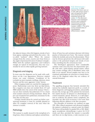 the adjacent tissues; when this happens, streaks of new
bone appear, radiating outwards from the cortex – the
so-called ‘sunburst’ effect. Where the tumour
emerges from the cortex, reactive new bone forms at
the angles of periosteal elevation (Codman’s triangle).
While both the sunburst appearance and Codman’s
triangle are typical of osteosarcoma, they may occa-
sionally be seen in other rapidly growing tumours.
Diagnosis and staging
In most cases the diagnosis can be made with conﬁ-
dence on the x-ray appearances. However, atypical
lesions can cause confusion. Conditions to be
excluded are post-traumatic swellings, infection, stress
fracture and the more aggressive ‘cystic’ lesions.
Other imaging studies are essential for staging pur-
poses. Radioisotope scans may show up skip lesions,
but a negative scan does not exclude them. CT and
MRI reliably show the extent of the tumour. Chest x-
rays are done routinely, but pulmonary CT is a much
more sensitive detector of lung metastases. About 10
per cent of patients have pulmonary metastases by the
time they are ﬁrst seen.
A biopsy should always be carried out before com-
mencing treatment; it must be carefully planned to
allow for complete removal of the tract when the
tumour is excised.
Pathology
The tumour is usually situated in the metaphysis of a
long bone, where it destroys and replaces normal bone.
Areas of bone loss and cavitation alternate with dense
patches of abnormal new bone. The tumour extends
within the medulla and across the physeal plate. There
may be obvious spread into the soft tissues with ossiﬁ-
cation at the periosteal margins and streaks of new
bone extending into the extraosseous mass.
The histological appearances show considerable
variation: some areas may have the characteristic spin-
dle cells with a pink-staining osteoid matrix; others
may contain cartilage cells or ﬁbroblastic tissue with
little or no osteoid. Several samples may have to be
examined; pathologists are reluctant to commit them-
selves to the diagnosis unless they see evidence of
osteoid formation.
Treatment
The appalling prognosis that formerly attended this
tumour has markedly improved, partly as a result of
better diagnostic and staging procedures, and possibly
because the average age of the patients has increased,
but mainly because of advances in chemotherapy to
control metastatic spread. However, it is still impor-
tant to eradicate the primary lesion completely; the
mortality rate after local recurrence is far worse than
following effective ablation at the ﬁrst encounter.
The principles of treatment are outlined on page
192. After clinical assessment and advanced imaging,
the patient is admitted to a special centre for biopsy.
The lesion will probably be graded IIA or IIB. Multi-
agent neoadjuvant chemotherapy is given for 8–12
weeks and then, provided the tumour is resectable
and there are no skip lesions, a wide resection is car-
GENERALORTHOPAEDICS
208
9 9.26 Osteosarcoma –
pathology (a) After
resection this lesion was cut
in half; pale tumour tissue is
seen occupying the distal
third of the femur and
extending through the
cortex. (b) The dominant
features in the histological
sections were malignant
stromal tissue showing
osteoid formation (pink
masses). (×480) (c) The same
tumour showed areas of
chondroblastic
differentiation. (×480)
(a) (c)
(b)
 