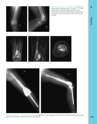 Tumours
209
9
(a) (b)
9.27 Osteosarcoma – imaging (a,b) X-rays of a
distal femoral osteosarcoma in a child. (c,d,e) MRI
examination: coronal, sagittal and axial scans
showing the intra-and extra-osseous extensions of
the tumour and its proximity to the neurovascular
bundle.
9.28 Osteosarcoma – operative treatment Postoperative x-rays showing an endoprosthetic replacement following wide
resection of the lesion (Stanmore Implants Worldwide).
(c) (d) (e)
 