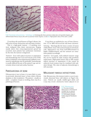 X-ray shows the usual features of Paget’s disease, but
with areas of bone destruction and soft-tissue invasion.
This is a high-grade tumour – if anything even
more malignant than classic osteosarcoma. Staging
usually shows that extracompartmental spread has
occurred; most patients have pulmonary metastases
by the time the tumour is diagnosed.
Treatment Even with radical resection or amputation
and chemotherapy the 5-year survival rate is low. If the
lesion is deﬁnitely extracompartmental, palliative treat-
ment by radiotherapy may be preferable; chemotherapy
is usually difﬁcult because of the patient’s age and un-
certainty about renal and cardiac function.
FIBROSARCOMA OF BONE
Fibrosarcoma is rare in bone; it is more likely to arise
in previously abnormal tissue (a bone infarct, ﬁbrous
dysplasia or after irradiation). The patient – usually an
adult – complains of pain or swelling; there may be a
pathological fracture.
X-ray shows an undistinctive area of bone destruc-
tion. CT or MRI will reveal the soft-tissue extension.
Pathology Histologically the lesion consists of masses
of ﬁbroblastic tissue with scattered atypical and mitotic
cells. Appearances vary from well-differentiated to
highly undifferentiated, and the tumours are some-
times graded accordingly.
Treatment Low-grade, well-conﬁned tumours (stage
IA) can be treated by wide excision with prosthetic
replacement. High-grade lesions (IIA or IIB) require
radical resection or amputation; if this cannot be
achieved, local excision must be combined with radi-
ation therapy. The value of adjuvant chemotherapy is
still uncertain.
MALIGNANT FIBROUS HISTIOCYTOMA
Like ﬁbrosarcoma, this tumour tends to occur in pre-
viously abnormal bone (old infarcts or Paget’s dis-
ease). Patients are usually middle-aged adults and
x-rays may reveal a destructive lesion adjacent to an
Tumours
211
9
(a) (b)
9.30 Parosteal osteosarcoma – histology (a) Histologically there are bony trabeculae and spindle-shaped, well-
differentiated ﬁbrous tissue cells with occasional mitotic ﬁgures. (×120) (b) High-power view of the same. (×300)
9.31 Fibrosarcoma
(a) The area of bone
destruction in the femoral
condyle has no special
distinguishing features.
(b) The biopsy showed
highly atypical ﬁbroblastic
tissue.
(a) (b)
 