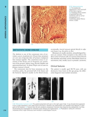 METASTATIC BONE DISEASE
The skeleton is one of the commonest sites of sec-
ondary cancer; in patients over 50 years bone metastases
are seen more frequently than all primary malignant
bone tumours together. The commonest source is car-
cinoma of the breast; next in frequency are carcino-
mas of the prostate, kidney, lung, thyroid, bladder and
gastrointestinal tract. In about 10 per cent of cases no
primary tumour is found.
The commonest sites for bone metastases are the
vertebrae, pelvis, the proximal half of the femur and
the humerus. Spread is usually via the blood stream;
occasionally, visceral tumours spread directly to adja-
cent bones (e.g. the pelvis or ribs).
Metastases are usually osteolytic, and pathological frac-
tures are common. Bone resorption is due either to the
direct action of tumour cells or to tumour-derived factors
that stimulate osteoclastic activity. Osteoblastic lesions are
uncommon; they usually occur in prostatic carcinoma.
Clinical features
The patient is usually aged 50–70 years; with any
destructive bone lesion in this age group, the differ-
ential diagnosis must include metastasis.
GENERALORTHOPAEDICS
216
9
9.40 Metastatic tumours (a,b) This patient presented with pain in the right upper thigh. X-ray showed what appeared
to be a single metastasis in the upper third of the femur. However, the radioisotope scan revealed many deposits in other
parts of the skeleton. (c) Patients over 60 with vertebral compression fractures may simply be very osteoporotic, but they
should always be investigated for metastatic bone disease and myelomatosis. (d) Prophylactic nailing for a femoral
metastasis which might otherwise have resulted in a pathological fracture.
(a) (b) (c) (d)
9.39 Adamantinoma
(a) The bubble-like
appearance in the mid-shaft
of the tibia is typical.
(b) Histology shows clusters
of epithelial-like cells,
sometimes with an acinar
arrangement in a
moderately cellular ﬁbrous
stroma. (×300)
(a) (b)
 