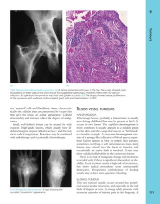 tive ‘synovial’ cells and ﬁbroblastic tissue; characteris-
tically the cellular areas are punctured by vacant slits
that give the tissue an acinar appearance. Cellular
abnormality and mitoses reﬂect the degree of malig-
nancy.
Small, well-deﬁned lesions can be treated by wide
excision. High-grade lesions, which usually have ill-
deﬁned margins, require radical resection – and this may
mean radical amputation. Resection may be combined
with radiotherapy and occasionally chemotherapy.
BLOOD VESSEL TUMOURS
HAEMANGIOMA
This benign lesion, probably a hamartoma, is usually
seen during childhood but may be present at birth. It
occurs in two forms. The capillary haemangioma is
more common; it usually appears as a reddish patch
on the skin, and the congenital naevus or ‘birthmark’
is a familiar example. A cavernous haemangioma con-
sists of a sponge-like collection of blood spaces; super-
ﬁcial lesions appear as blue or purple skin patches,
sometimes overlying a soft subcutaneous mass; deep
lesions may extend into the fascia or muscles, and
occasionally an entire limb is involved. X-rays may
show calciﬁed phleboliths in the cavernous lesions.
There is no risk of malignant change and treatment
is needed only if there is signiﬁcant discomfort or dis-
ability. Local excision carries a high risk of recurrence,
but more radical procedures seem unnecessarily
destructive. Preoperative embolization of feeding
vessels may reduce intra-operative bleeding.
GLOMUS TUMOUR
This rare tumour usually occurs around ﬁne periph-
eral neurovascular structures, and especially in the nail
beds of ﬁngers or toes. A young adult presents with
recurrent episodes of intense pain in the ﬁngertip. A
Tumours
221
9
(a) (b)
9.42 Pigmented villonodular synovitis (a) A farmer presented with pain in the hip. The x-rays showed cystic
excavations on both sides of the joint and at ﬁrst suggested tuberculosis. However, there were no signs of
infection. At operation the synovium was thick and golden in colour. (b) The biopsy showed dense proliferation
of the synovium with scattered multinucleated giant cells and haemosiderin. (×120)
9.43 Malignant synoviomas X-rays showing the
so-called ‘snowstorm’ appearance.
 