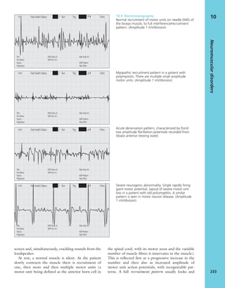 screen and, simultaneously, crackling sounds from the
loudspeaker.
At rest, a normal muscle is silent. As the patient
slowly contracts the muscle there is recruitment of
one, then more and then multiple motor units (a
motor unit being deﬁned as the anterior horn cell in
the spinal cord, with its motor axon and the variable
number of muscle ﬁbres it innervates in the muscle).
This is reﬂected ﬁrst as a progressive increase in the
number and then also as increased amplitude of
motor unit action potentials, with recognizable pat-
terns. A full recruitment pattern usually looks and
Neuromusculardisorders
233
101mV Foot Switch Status: / Run Trig: uV 10ms
Fibs:
Pos Waves:
Fascics:
Polyphasics:
MUP Amp uV:
MUP Dur ms:
Max Amp mV:
MUP Pattern:
Max Effort:
1mV Foot Switch Status: / Run Trig: uV 10ms
Fibs:
Pos Waves:
Fascics:
Polyphasics:
MUP Amp uV:
MUP Dur ms:
Max Amp mV:
MUP Pattern:
Max Effort:
1mV Foot Switch Status: / Run Trig: uV 10ms
Fibs:
Pos Waves:
Fascics:
Polyphasics:
MUP Amp uV:
MUP Dur ms:
Max Amp mV:
MUP Pattern:
Max Effort:
1mV Foot Switch Status: / Run Trig: uV 10ms
Fibs:
Pos Waves:
Fascics:
Polyphasics:
MUP Amp uV:
MUP Dur ms:
Max Amp mV:
MUP Pattern:
Max Effort:
10.9 Electromyography
Normal recruitment of motor units on needle EMG of
the biceps muscle, to full interference/recruitment
pattern. (Amplitude 1 mV/division)
Myopathic recruitment pattern in a patient with
polymyositis. There are multiple small amplitude
motor units. (Amplitude 1 mV/division)
Acute denervation pattern, characterized by ﬂorid
low amplitude ﬁbrillation potentials recorded from
tibialis anterior (resting state).
Severe neurogenic abnormality. Single rapidly ﬁring
giant motor potential, typical of severe motor unit
loss in a patient with old poliomyelitis. A similar
pattern is seen in motor neuron disease. (Amplitude
1 mV/division)
 