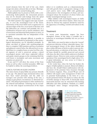 neural elements form the roof of the cyst, which
merges into plum-coloured skin at its base. Meningo-
celes are covered by normal looking skin.
Hydrocephalus may be present at birth; with a com-
municating hydrocephalus the intracranial pressure
may not be elevated until leakage from the spinal
lesion is arrested by surgical closure of the lesion.
The baby’s posture may suggest some type of paral-
ysis, or even the neurological level of the lesion.
Deformities of the lower limbs such as equinovarus or
calcaneovalgus of the feet, recurvatum of the knee and
hip dislocation are common and probably due to a
combination of factors such as muscle imbalance, lack
of movement and abnormal limb position in utero, or
to associated anomalies that are independent of the
paralysis.
Muscle charting, although difﬁcult, is possible in
the neonate and should be performed so that neuro-
logical deterioration can be identiﬁed promptly. In
about one-third of infants with myelomeningocele
there is complete LMN paralysis and loss of sensation
and sphincter control below the affected level; in one-
third there is a complete lesion at some level but a dis-
tal segment of cord is preserved, giving a mixed
neurological picture with intact segmental reﬂexes
and spastic muscle groups; in the remaining third the
cord lesion is incomplete and some movement and
sensation are preserved.
X-rays and CT will show the extent of the bony
lesion as well as other vertebral anomalies. MRI may
be helpful to deﬁne the neurological defects.
CLINICAL FEATURES IN OLDER CHILDREN
The minor forms of spina biﬁda may present clinically
at any age. The physical signs mentioned above may
have been noted previously and the child (or
teenager) now presents with clawing of the toes, a
change in gait pattern, incontinence or abnormal sen-
sation. This delayed presentation is often attributed to
the tethered cord syndrome. Tethering may be second-
ary to the early surgical reconstruction of the major
defect or to conditions such as a diastematomyelia,
and with growth there is progressive damage to the
cord and/or nerve roots. MRI with gadolinium
enhancement is the investigation of choice and neu-
rosurgical release the treatment of choice before any
further neurological damage occurs.
Older children with neurological lesions are liable
to suffer fractures after minor injuries. These may not
always be obvious but suspicion should be raised by
the appearance of swelling, warmth and redness in the
limb.
Treatment
In recent years intrauterine surgery has been
attempted: closure of the defect is possible but a
reduction in neurological disability has not yet been
identiﬁed.
After birth, care must be taken to dress the ‘wound’
and prevent infection of these vulnerable tissues. For-
mal neurosurgical closure of the defect should take
place within 48 hours of birth in order to prevent dry-
ing and ulceration, or infection of the lesion. All neu-
ral tissue should be carefully preserved and covered
with dura; the skin is then widely undercut to facilitate
complete closure. However some centres avoid urgent
operation if the neurological level is high (above L1),
if spinal deformities are very severe or if there is
marked hydrocephalus.
A few weeks later, when the back has healed, the
degree of hydrocephalus is assessed. Almost all children
also have the Arnold–Chiari malformation with dis-
placement of the posterior fossa structures through
the foramen magnum. Thus, around 90 per cent of
children will require active management of their real
or potential hydrocephalus in the form of a ven-
triculo-peritoneal shunt (VP shunt) to reduce the risk
of further damage to their CNS. A chronically raised
intracranial pressure may be associated with learning
difﬁculties and other problems. Similarly, if a child’s
neurological status changes unexpectedly, shunt
Neuromusculardisorders
249
10
10.18 Spina biﬁda
(a) Baby with spina biﬁda
cystica (myelomeningocele).
(b) Tuft of hair over the
lumbosacral junction. X-ray in
this case showed a sacral
defect (c).
(a) (b) (c)
 