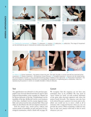 GENERALORTHOPAEDICS
8
1
Test
The apprehension test referred to in the previous para-
graph is one of several clinical tests that are used to elicit
suspected abnormalities: some examples are Thomas’ test
for ﬂexion deformity of the hip, Trendelenburg’s test for
instability of the hip, McMurray’s test for a torn meniscus
of the knee, Lachman’s test for cruciate ligament insta-
bility and various tests for intra-articular ﬂuid. These and
others are described in the relevant chapters in Section 2.
Tests for muscle tone, motor power, reﬂexes and
various modes of sensibility are part and parcel of neu-
rological examination, which is dealt with on page 10.
Caveat
We recognize that the sequence set out here may
sometimes have to be modiﬁed. We may need to
‘move’ before we ‘look’: an early scoliotic deformity
of the spine often becomes apparent only when the
patient bends forwards. The sequence may also have
to be altered because a patient is in severe pain or dis-
abled: you would not try to move a limb at all in
someone with a suspected fracture when an x-ray can
provide the answer. When examining a child you may
have to take your chances with look or feel or move
whenever you can!
(a) (b) (c)
(d) (e) (f)
1.5 Testing for movement (a) Flexion, (b) extension, (c) rotation, (d) abduction, (e) adduction. The range of movement
can be estimated by eye or measured accurately using a goniometer (f).
1.6 Move (a) Active movement – the patient moves the joint. The right shoulder is normal; the left has restricted active
movement. (b) Passive movement – the examiner moves the joint. (c) Unstable movement – the joint can be moved across
the normal planes of action, in this case demonstrating valgus instability of the right knee. (d) Provocative movement – the
examiner moves (or manipulates) the joint so as to provoke the symptoms of impending pain or dislocation. Here he is
reproducing the position in which an unstable shoulder is likely to dislocate.
(a) (b) (c) (d)
 
