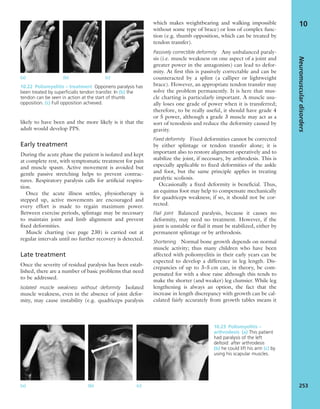 likely to have been and the more likely is it that the
adult would develop PPS.
Early treatment
During the acute phase the patient is isolated and kept
at complete rest, with symptomatic treatment for pain
and muscle spasm. Active movement is avoided but
gentle passive stretching helps to prevent contrac-
tures. Respiratory paralysis calls for artiﬁcial respira-
tion.
Once the acute illness settles, physiotherapy is
stepped up, active movements are encouraged and
every effort is made to regain maximum power.
Between exercise periods, splintage may be necessary
to maintain joint and limb alignment and prevent
ﬁxed deformities.
Muscle charting (see page 230) is carried out at
regular intervals until no further recovery is detected.
Late treatment
Once the severity of residual paralysis has been estab-
lished, there are a number of basic problems that need
to be addressed.
Isolated muscle weakness without deformity Isolated
muscle weakness, even in the absence of joint defor-
mity, may cause instability (e.g. quadriceps paralysis
which makes weightbearing and walking impossible
without some type of brace) or loss of complex func-
tion (e.g. thumb opposition, which can be treated by
tendon transfer).
Passively correctible deformity Any unbalanced paraly-
sis (i.e. muscle weakness on one aspect of a joint and
greater power in the antagonists) can lead to defor-
mity. At first this is passively correctable and can be
counteracted by a splint (a calliper or lightweight
brace). However, an appropriate tendon transfer may
solve the problem permanently. It is here that mus-
cle charting is particularly important. A muscle usu-
ally loses one grade of power when it is transferred;
therefore, to be really useful, it should have grade 4
or 5 power, although a grade 3 muscle may act as a
sort of tenodesis and reduce the deformity caused by
gravity.
Fixed deformity Fixed deformities cannot be corrected
by either splintage or tendon transfer alone; it is
important also to restore alignment operatively and to
stabilize the joint, if necessary, by arthrodesis. This is
especially applicable to ﬁxed deformities of the ankle
and foot, but the same principle applies in treating
paralytic scoliosis.
Occasionally a ﬁxed deformity is beneﬁcial. Thus,
an equinus foot may help to compensate mechanically
for quadriceps weakness; if so, it should not be cor-
rected.
Flail joint Balanced paralysis, because it causes no
deformity, may need no treatment. However, if the
joint is unstable or ﬂail it must be stabilized, either by
permanent splintage or by arthrodesis.
Shortening Normal bone growth depends on normal
muscle activity; thus many children who have been
affected with poliomyelitis in their early years can be
expected to develop a difference in leg length. Dis-
crepancies of up to 3–5 cm can, in theory, be com-
pensated for with a shoe raise although this tends to
make the shorter (and weaker) leg clumsier. While leg
lengthening is always an option, the fact that the
increase in length discrepancy with growth can be cal-
culated fairly accurately from growth tables means it
Neuromusculardisorders
253
10
(a) (b) (c)
10.22 Poliomyelitis – treatment Opponens paralysis has
been treated by superﬁcialis tendon transfer. In (b) the
tendon can be seen in action at the start of thumb
opposition. (c) Full opposition achieved.
10.23 Poliomyelitis –
arthrodesis (a) This patient
had paralysis of the left
deltoid: after arthrodesis
(b) he could lift his arm (c) by
using his scapular muscles.
(a) (b) (c)
 