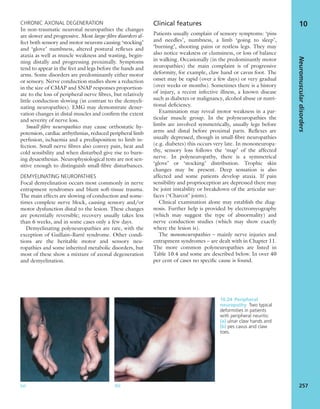 CHRONIC AXONAL DEGENERATION
In non-traumatic neuronal neuropathies the changes
are slower and progressive. Most large-ﬁbre disorders af-
fect both sensory and motor neurons causing ‘stocking’
and ‘glove’ numbness, altered postural reﬂexes and
ataxia as well as muscle weakness and wasting, begin-
ning distally and progressing proximally. Symptoms
tend to appear in the feet and legs before the hands and
arms. Some disorders are predominantly either motor
or sensory. Nerve conduction studies show a reduction
in the size of CMAP and SNAP responses proportion-
ate to the loss of peripheral nerve ﬁbres, but relatively
little conduction slowing (in contrast to the demyeli-
nating neuropathies). EMG may demonstrate dener-
vation changes in distal muscles and conﬁrm the extent
and severity of nerve loss.
Small-ﬁbre neuropathies may cause orthostatic hy-
potension, cardiac arrhythmias, reduced peripheral limb
perfusion, ischaemia and a predisposition to limb in-
fection. Small nerve ﬁbres also convey pain, heat and
cold sensibility and when disturbed give rise to burn-
ing dysaesthesias. Neurophysiological tests are not sen-
sitive enough to distinguish small-ﬁbre disturbances.
DEMYELINATING NEUROPATHIES
Focal demyelination occurs most commonly in nerve
entrapment syndromes and blunt soft-tissue trauma.
The main effects are slowing of conduction and some-
times complete nerve block, causing sensory and/or
motor dysfunction distal to the lesion. These changes
are potentially reversible; recovery usually takes less
than 6 weeks, and in some cases only a few days.
Demyelinating polyneuropathies are rare, with the
exception of Guillain–Barré syndrome. Other condi-
tions are the heritable motor and sensory neu-
ropathies and some inherited metabolic disorders, but
most of these show a mixture of axonal degeneration
and demyelination.
Clinical features
Patients usually complain of sensory symptoms: ‘pins
and needles’, numbness, a limb ‘going to sleep’,
‘burning’, shooting pains or restless legs. They may
also notice weakness or clumsiness, or loss of balance
in walking. Occasionally (in the predominantly motor
neuropathies) the main complaint is of progressive
deformity, for example, claw hand or cavus foot. The
onset may be rapid (over a few days) or very gradual
(over weeks or months). Sometimes there is a history
of injury, a recent infective illness, a known disease
such as diabetes or malignancy, alcohol abuse or nutri-
tional deﬁciency.
Examination may reveal motor weakness in a par-
ticular muscle group. In the polyneuropathies the
limbs are involved symmetrically, usually legs before
arms and distal before proximal parts. Reﬂexes are
usually depressed, though in small-ﬁbre neuropathies
(e.g. diabetes) this occurs very late. In mononeuropa-
thy, sensory loss follows the ‘map’ of the affected
nerve. In polyneuropathy, there is a symmetrical
‘glove’ or ‘stocking’ distribution. Trophic skin
changes may be present. Deep sensation is also
affected and some patients develop ataxia. If pain
sensibility and proprioception are depressed there may
be joint instability or breakdown of the articular sur-
faces (‘Charcot’ joints).
Clinical examination alone may establish the diag-
nosis. Further help is provided by electromyography
(which may suggest the type of abnormality) and
nerve conduction studies (which may show exactly
where the lesion is).
The mononeuropathies – mainly nerve injuries and
entrapment syndromes – are dealt with in Chapter 11.
The more common polyneuropathies are listed in
Table 10.4 and some are described below. In over 40
per cent of cases no speciﬁc cause is found.
Neuromusculardisorders
257
10
10.24 Peripheral
neuropathy Two typical
deformities in patients
with peripheral neuritis:
(a) ulnar claw hands and
(b) pes cavus and claw
toes.
(a) (b)
 