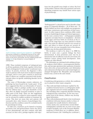 1990. These included symptoms of widespread pain
in all four quadrants of the body, together with at least
9 pairs of designated ‘tender points’ on physical exam-
ination. In practice, however, the diagnosis is often
made in patients with much more localized symptoms
and signs, and it is now quite common to attach this
label to almost any condition associated with myofas-
cial pain where no speciﬁc underlying disorder can be
identiﬁed.
The cause of ﬁbromyalgia remains unknown; no
pathology has been found in the ‘tender spots’. It has
been suggested that this is an abnormality of ‘sensory
processing’, which is perhaps another way of saying
that the sufferers have a ‘low pain threshold’; in fact
they often do display increased sensitivity to pain in
other parts of the body. There are also suggestions
that the condition is related to stress responses which
can be activated by sudden accidents or traumatic life
events. This does not mean that such patients will
necessarily show other features of psychological dys-
function and the condition cannot be excluded merely
by psychological testing.
In mild cases, treatment can be limited to keeping
up muscle tone and general ﬁtness (hence the advice
to have physiotherapy and then continue with daily
exercises on their own), perhaps together with injec-
tions into the painful areas simply to reduce the level
of discomfort. Patients with more persistent and more
disturbing symptoms may beneﬁt from various types
of psychotherapy.
ARTHROGRYPOSIS
‘Arthrogryposis’ is a broad term used to describe a large
group of congenital disorders – all of them rare – in
which children are born with multiple non-progressive
soft-tissue contractures and restriction of joint move-
ment. In other respects these conditions differ widely
in terms of pathological change and clinical appearance.
In the most common form – arthrogryposis multiplex
congenita (nowadays known as amyoplasia) – all joints
of the upper and lower limbs are involved; at the ex-
tremes of the range there are some patients in whom
only a few joints are affected (and not very severely at
that) and others in whom all joints are severely af-
fected. In the very rare myopathic form of the disease,
children may develop spinal deformities.
The incidence is said to be about 1 in 3000 live
births; in some cases a genetic linkage has been
demonstrated. A more proximate cause may be an
intrauterine lack of sufﬁcient room for movement (for
whatever reason) during foetal development. Joint
capsules are often ﬁbrotic.
The deformities are associated with unbalanced mus-
cle weakness which follows a neurosegmental distribu-
tion, and necropsy specimens show sparseness of anterior
horn cells in the cervical and lumbar cord. Deformities
and contractures develop in utero and remain largely un-
changed throughout life. Myopathic and neuropathic
features may coexist in the same muscle.
Classification
Considering arthrogryposis as a whole, the conditions
can be placed in three major categories:
1. Those with total body involvement: typiﬁed by the
condition formerly known as arthrogryposis multi-
plex congenita and now termed amyoplasia, but
also including other congenital disorders showing
widespread joint contractures. In the rarer myo-
pathic form of the disease, children may develop
spinal deformities.
2. Those with predominantly hand or foot involvement:
conditions with joint features similar to those of
amyoplasia but usually limited to distal joints
(wrists, hands, feet) and therefore termed distal
arthrogryposis; included also are more severe types
of distal myopathy such as the Freeman–Sheldon
syndrome in which there are, in addition, abnor-
mal facial features (the ‘whistling face syndrome’).
Neuromusculardisorders
263
10
(b)
10.29 Complex regional pain syndrome (a) A 53-year
old woman suffered an undisplaced fracture of her right
tibia. The fracture healed but her foot became swollen,
warm to the touch and tender, the skin reddish-purple and
sweaty. (b) X-rays showed an unusual degree of
osteoporosis.
(a)
 