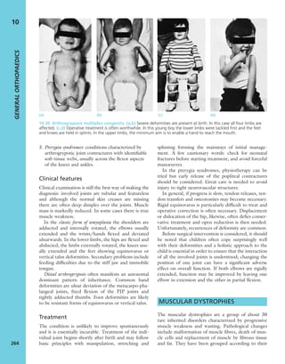 3. Pterygia syndromes: conditions characterized by
arthrogrypotic joint contractures with identiﬁable
soft-tissue webs, usually across the ﬂexor aspects
of the knees and ankles.
Clinical features
Clinical examination is still the best way of making the
diagnosis: involved joints are tubular and featureless
and although the normal skin creases are missing
there are often deep dimples over the joints. Muscle
mass is markedly reduced. In some cases there is true
muscle weakness.
In the classic form of amyoplasia the shoulders are
adducted and internally rotated, the elbows usually
extended and the wrists/hands ﬂexed and deviated
ulnarwards. In the lower limbs, the hips are ﬂexed and
abducted, the limbs externally rotated, the knees usu-
ally extended and the feet showing equinovarus or
vertical talus deformities. Secondary problems include
feeding difﬁculties due to the stiff jaw and immobile
tongue.
Distal arthrogryposis often manifests an autosomal
dominant pattern of inheritance. Common hand
deformities are ulnar deviation of the metacarpo-pha-
langeal joints, ﬁxed ﬂexion of the PIP joints and
tightly adducted thumbs. Foot deformities are likely
to be resistant forms of equinovarus or vertical talus.
Treatment
The condition is unlikely to improve spontaneously
and it is essentially incurable. Treatment of the indi-
vidual joint begins shortly after birth and may follow
basic principles with manipulation, stretching and
splinting forming the mainstays of initial manage-
ment. A few cautionary words: check for neonatal
fractures before starting treatment, and avoid forceful
manoeuvres.
In the pterygia syndromes, physiotherapy can be
tried but early release of the popliteal contractures
should be considered. Great care is needed to avoid
injury to tight neurovascular structures.
In general, if progress is slow, tendon releases, ten-
don transfers and osteotomies may become necessary.
Rigid equinovarus is particularly difﬁcult to treat and
operative correction is often necessary. Displacement
or dislocation of the hip, likewise, often deﬁes conser-
vative treatment and open reduction is then needed.
Unfortunately, recurrences of deformity are common.
Before surgical intervention is considered, it should
be noted that children often cope surprisingly well
with their deformities and a holistic approach to the
child is essential in order to ensure that the interaction
of all the involved joints is understood; changing the
position of one joint can have a signiﬁcant adverse
effect on overall function. If both elbows are rigidly
extended, function may be improved by leaving one
elbow in extension and the other in partial ﬂexion.
MUSCULAR DYSTROPHIES
The muscular dystrophies are a group of about 30
rare inherited disorders characterized by progressive
muscle weakness and wasting. Pathological changes
include malformation of muscle ﬁbres, death of mus-
cle cells and replacement of muscle by ﬁbrous tissue
and fat. They have been grouped according to their
GENERALORTHOPAEDICS
264
10
(a) (b) (c) (d)
10.30 Arthrogryposis multiplex congenita (a,b) Severe deformities are present at birth. In this case all four limbs are
affected. (c,d) Operative treatment is often worthwhile. In this young boy the lower limbs were tackled ﬁrst and the feet
and knees are held in splints. In the upper limbs, the minimum aim is to enable a hand to reach the mouth.
 