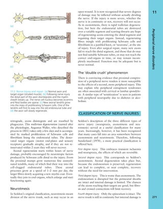 retrograde, axons disintegrate and are resorbed by
phagocytes. This wallerian degeneration (named after
the physiologist, Augustus Waller, who described the
process in 1851) takes only a few days and is accompa-
nied by marked proliferation of Schwann cells and
ﬁbroblasts lining the endoneurial tubes. The dener-
vated target organs (motor end-plates and sensory
receptors) gradually atrophy, and if they are not re-
innervated within 2 years they will never recover.
Axonal regeneration starts within hours of nerve
damage, probably encouraged by neurotropic factors
produced by Schwann cells distal to the injury. From
the proximal stumps grow numerous ﬁne unmyeli-
nated tendrils, many of which ﬁnd their way into the
cell-clogged endoneurial tubes. These axonal
processes grow at a speed of 1–2 mm per day, the
larger ﬁbres slowly acquiring a new myelin coat. Even-
tually they join to end-organs, which enlarge and start
functioning again.
Neurotmesis
In Seddon’s original classiﬁcation, neurotmesis meant
division of the nerve trunk, such as may occur in an
open wound. It is now recognized that severe degrees
of damage may be inﬂicted without actually dividing
the nerve. If the injury is more severe, whether the
nerve is in continuity or not, recovery will not occur.
As in axonotmesis, there is rapid wallerian degenera-
tion, but here the endoneurial tubes are destroyed
over a variable segment and scarring thwarts any hope
of regenerating axons entering the distal segment and
regaining their target organs. Instead, regenerating
ﬁbres mingle with proliferating Schwann cells and
ﬁbroblasts in a jumbled knot, or ‘neuroma’, at the site
of injury. Even after surgical repair, many new axons
fail to reach the distal segment, and those that do may
not ﬁnd suitable Schwann tubes, or may not reach the
correct end-organs in time, or may remain incom-
pletely myelinated. Function may be adequate but is
never normal.
The ‘double crush’ phenomenon
There is convincing evidence that proximal compres-
sion of a peripheral nerve renders it more susceptible
to the effects of a second, more peripheral injury. This
may explain why peripheral entrapment syndromes
are often associated with cervical or lumbar spondylo-
sis. A similar type of ‘sensitization’ is seen in patients
with peripheral neuropathy due to diabetes or alco-
holism.
CLASSIFICATION OF NERVE INJURIES
Seddon’s description of the three different types of
nerve injury (neurapraxia, axonotmesis and neu-
rotmesis) served as a useful classiﬁcation for many
years. Increasingly, however, it has been recognized
that many cases fall into an area somewhere between
axonotmesis and neurotmesis. Therefore, following
Sunderland (1978), a more practical classiﬁcation is
offered here.
First degree injury This embraces transient ischaemia
and neurapraxia, the effects of which are reversible.
Second degree injury This corresponds to Seddon’s
axonotmesis. Axonal degeneration takes place but,
because the endoneurium is preserved, regeneration
can lead to complete, or near complete, recovery
without the need for intervention.
Third degree injury This is worse than axonotmesis. The
endoneurium is disrupted but the perineurial sheaths
are intact and internal damage is limited. The chances
of the axons reaching their targets are good, but ﬁbro-
sis and crossed connections will limit recovery.
Fourth degree injury Only the epineurium is intact. The
nerve trunk is still in continuity but internal damage is
Peripheralnervedisorders
271
11
(a)
(b)
(c)
(d)
11.2 Nerve injury and repair (a) Normal axon and
target organ (striated muscle). (b) Following nerve injury
the distal part of the axon disintegrates and the myelin
sheath breaks up. The nerve cell nucleus becomes eccentric
and Nissl bodies are sparse. (c) New axonal tendrils grow
into the mass of proliferating Schwann cells. One of the
tendrils will ﬁnd its way into the old endoneurial tube and
(d) the axon will slowly regenerate.
 