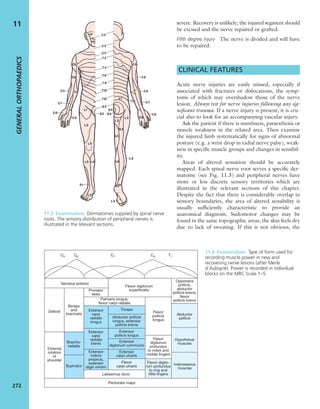 severe. Recovery is unlikely; the injured segment should
be excised and the nerve repaired or grafted.
Fifth degree injury The nerve is divided and will have
to be repaired.
CLINICAL FEATURES
Acute nerve injuries are easily missed, especially if
associated with fractures or dislocations, the symp-
toms of which may overshadow those of the nerve
lesion. Always test for nerve injuries following any sig-
niﬁcant trauma. If a nerve injury is present, it is cru-
cial also to look for an accompanying vascular injury.
Ask the patient if there is numbness, paraesthesia or
muscle weakness in the related area. Then examine
the injured limb systematically for signs of abnormal
posture (e.g. a wrist drop in radial nerve palsy), weak-
ness in speciﬁc muscle groups and changes in sensibil-
ity.
Areas of altered sensation should be accurately
mapped. Each spinal nerve root serves a speciﬁc der-
matome (see Fig. 11.3) and peripheral nerves have
more or less discrete sensory territories which are
illustrated in the relevant sections of this chapter.
Despite the fact that there is considerable overlap in
sensory boundaries, the area of altered sensibility is
usually sufﬁciently characteristic to provide an
anatomical diagnosis. Sudomotor changes may be
found in the same topographic areas; the skin feels dry
due to lack of sweating. If this is not obvious, the
GENERALORTHOPAEDICS
272
11
11.3 Examination Dermatomes supplied by spinal nerve
roots. The sensory distribution of peripheral nerves is
illustrated in the relevant sections.
Serratus anterior
Deltoid
Biceps
and
brachialis
Brachio-
radialis
External
rotators
of
shoulder
Pectoralis major
Latissimus dorsi
Extensor
indicis
proprius,
extensor
digiti minimi
Extensor
carpi
radialis
brevis
Extensor
pollicis longus
Extensor
digitorum communis
Extensor
carpi ulnaris
Flexor
carpi ulnarisSupinator
Pronator
teres
Extensor
carpi
radialis
longus
Flexor digitorum
superficialis
Palmaris longus,
flexor carpi radialis
Abductor pollicis
longus, extensor
pollicis brevis
Triceps
Flexor
pollicis
longus
Abductor
pollicis
Hypothenar
muscles
Interosseous
muscles
Flexor
digitorum
profundus
to index and
middle fingers
Flexor digito-
rum profundus
to ring and
little fingers
Opponens
pollicis,
abductor
pollicis brevis,
flexor
pollicis brevis
C5 C6 C7 C8 T1
11.4 Examination Type of form used for
recording muscle power in new and
recovering nerve lesions (after Merle
d’Aubigné). Power is recorded in individual
blocks on the MRC Scale 1–5.
 
