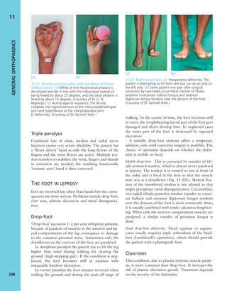 Apley's shoulderjt examination