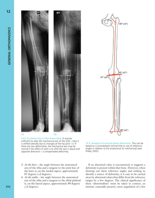 Apley's shoulderjt examination