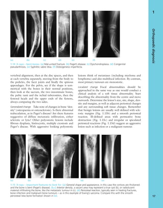 vertebral alignment, then at the disc spaces, and then
at each vertebra separately, moving from the body to
the pedicles, the facet joints and ﬁnally the spinous
appendages. For the pelvis, see if the shape is sym-
metrical with the bones in their normal positions,
then look at the sacrum, the two innominate bones,
the pubic rami and the ischial tuberosities, then the
femoral heads and the upper ends of the femora,
always comparing the two sides.
Generalized change Take note of changes in bone ‘den-
sity’ (osteopaenia or osteosclerosis). Is there abnormal
trabeculation, as in Paget’s disease? Are there features
suggestive of diffuse metastatic inﬁltration, either
sclerotic or lytic? Other polyostotic lesions include
ﬁbrous dysplasia, histiocyotis, multiple exostosis and
Paget’s disease. With aggressive looking polyostotic
lesions think of metastases (including myeloma and
lymphoma) and also multifocal infection. By contrast,
most primary tumours are monostotic.
Localized change Focal abnormalities should be
approached in the same way as one would conduct a
clinical analysis of a soft tissue abnormality. Start
describing the abnormality from the centre and move
outwards. Determine the lesion’s size, site, shape, den-
sity and margins, as well as adjacent periosteal changes
and any surrounding soft tissue changes. Remember
that benign lesions are usually well deﬁned with scle-
rotic margins (Fig. 1.15b) and a smooth periosteal
reaction. Ill-deﬁned areas with permeative bone
destruction (Fig. 1.15c) and irregular or spiculated
periosteal reactions (Fig. 1.15d) suggest an aggressive
lesion such as infection or a malignant tumour.
Orthopaedicdiagnosis
17
1
1.14 X-rays – bent bones (a) Mal-united fracture. (b) Paget’s disease. (c) Dyschondroplasia. (d) Congenital
pseudarthrosis. (e) Syphilitic sabre tibia. (f) Osteogenesis imperfecta.
(a) (b) (c) (d) (e) (f)
1.15 X-rays – important features to look for (a) General shape and appearance, in this case the cortices are thickened
and the bone is bent (Paget’s disease). (b,c) Interior density, a vacant area may represent a true cyst (b), or radiolucent
material inﬁltrating the bone, like the metastatic tumour in (c). (d) Periosteal reaction, typically seen in healing fractures,
bone infection and malignant bone tumours – as in this example of Ewing’s sarcoma. Compare this with the smooth
periosteal new bone formation shown in (e).
(a) (b) (c) (d) (e)
 