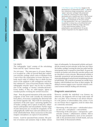 THE JOINTS
The radiographic ‘joint’ consists of the articulating
bones and the ‘space’ between them.
The ‘joint space’ The joint space is, of course, illusory;
it is occupied by a ﬁlm of synovial ﬂuid plus radiolu-
cent articular cartilage which varies in thickness from
1 mm or less (the carpal joints) to 6 mm (the knee). It
looks much wider in children than in adults because
much of the epiphysis is still cartilaginous and there-
fore radiolucent. Lines of increased density within the
radiographic articular ‘space’ may be due to calciﬁca-
tion of the cartilage or menisci (chondrocalcinosis).
Loose bodies, if they are radio-opaque, appear as
rounded patches overlying the normal structures.
Shape Note the general orientation of the joint and the
congruity of the bone ends (actually the subarticular
bone plates), if necessary comparing the abnormal with
the normal opposite side. Then look for narrowing or
asymmetry of the joint ‘space’: narrowing signiﬁes loss
of hyaline cartilage and is typical of infection, inﬂam-
matory arthropathies and osteoarthritis. Further stages
of joint destruction are revealed by irregularity of the
radiographically visible bone ends and radiolucent cysts
in the subchondral bone. Bony excrescences at the joint
margins (osteophytes) are typical of osteoarthritis.
Erosions Look for associated bone erosions. The posi-
tion of erosions and symmetry help to deﬁne various
types of arthropathy. In rheumatoid arthritis and psori-
asis the erosions are peri-articular (at the bare area where
the hyaline cartilage covering the joint has ended and the
intracapsular bone is exposed to joint ﬂuid). In gout the
erosions are further away from the articular surfaces and
are described as juxta-articular. Rheumatoid arthritis is
classically symmetrical and predominantly involves the
metacarpophalangeal and proximal interphalangeal joints
in both hands. The erosions in psoriasis are usually more
feathery with ill-deﬁned new bone at their margins. Ill-
deﬁned erosions suggest active synovitis whereas corti-
cated erosions indicate healing and chronicity.
Diagnostic associations
However carefully the individual x-ray features are
observed, the diagnosis will not leap ready-made off
the x-ray plate. Even a fracture is not always obvious.
It is the pattern of abnormalities that counts: if you
see one feature that is suggestive, look for others that
are commonly associated.
• Narrowing of the joint space + subchondral sclero-
sis and cysts + osteophytes = osteoarthritis.
• Narrowing of the joint space + osteoporosis + peri-
articular erosions = inﬂammatory arthritis. Add to
this the typical distribution, more or less symmetri-
cally in the proximal joints of both hands, and you
must think of rheumatoid arthritis.
GENERALORTHOPAEDICS
18
1 1.16 Plain x-rays of the hip Stages in the
development of osteoarthritis (OA). (a) Normal
hip: anatomical shape and position, with joint
‘space’ (articular cartilage) fully preserved.
(b) Early OA, showing joint space slightly
decreased and a subarticular cyst in the femoral
head. (c) Advanced OA: joint space markedly
decreased; osteophytes at the joint margin.
(d) Hip replacement: the cup is radiolucent but
its position is shown by a circumferential wire
marker. Note the differing image ‘densities’:
(1) the metal femoral implant; (2) the
polyethylene cup (radiolucent); (3) acrylic
cement impacted into the adjacent bone.
(a) (b)
(c) (d)
3
2
1
 