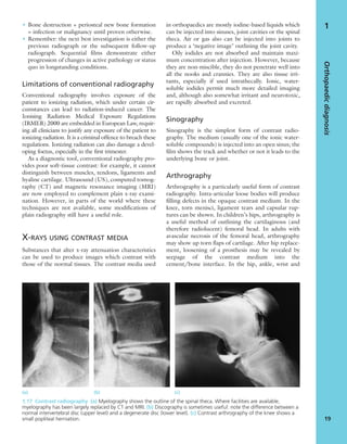 • Bone destruction + periosteal new bone formation
= infection or malignancy until proven otherwise.
• Remember: the next best investigation is either the
previous radiograph or the subsequent follow-up
radiograph. Sequential ﬁlms demonstrate either
progression of changes in active pathology or status
quo in longstanding conditions.
Limitations of conventional radiography
Conventional radiography involves exposure of the
patient to ionizing radiation, which under certain cir-
cumstances can lead to radiation-induced cancer. The
Ionising Radiation Medical Exposure Regulations
(IRMER) 2000 are embedded in European Law, requir-
ing all clinicians to justify any exposure of the patient to
ionizing radiation. It is a criminal offence to breach these
regulations. Ionizing radiation can also damage a devel-
oping foetus, especially in the ﬁrst trimester.
As a diagnostic tool, conventional radiography pro-
vides poor soft-tissue contrast: for example, it cannot
distinguish between muscles, tendons, ligaments and
hyaline cartilage. Ultrasound (US), computed tomog-
raphy (CT) and magnetic resonance imaging (MRI)
are now employed to complement plain x-ray exami-
nation. However, in parts of the world where these
techniques are not available, some modiﬁcations of
plain radiography still have a useful role.
X-RAYS USING CONTRAST MEDIA
Substances that alter x-ray attenuation characteristics
can be used to produce images which contrast with
those of the normal tissues. The contrast media used
in orthopaedics are mostly iodine-based liquids which
can be injected into sinuses, joint cavities or the spinal
theca. Air or gas also can be injected into joints to
produce a ‘negative image’ outlining the joint cavity.
Oily iodides are not absorbed and maintain maxi-
mum concentration after injection. However, because
they are non-miscible, they do not penetrate well into
all the nooks and crannies. They are also tissue irri-
tants, especially if used intrathecally. Ionic, water-
soluble iodides permit much more detailed imaging
and, although also somewhat irritant and neurotoxic,
are rapidly absorbed and excreted.
Sinography
Sinography is the simplest form of contrast radio-
graphy. The medium (usually one of the ionic water-
soluble compounds) is injected into an open sinus; the
ﬁlm shows the track and whether or not it leads to the
underlying bone or joint.
Arthrography
Arthrography is a particularly useful form of contrast
radiography. Intra-articular loose bodies will produce
ﬁlling defects in the opaque contrast medium. In the
knee, torn menisci, ligament tears and capsular rup-
tures can be shown. In children’s hips, arthrography is
a useful method of outlining the cartilaginous (and
therefore radiolucent) femoral head. In adults with
avascular necrosis of the femoral head, arthrography
may show up torn ﬂaps of cartilage. After hip replace-
ment, loosening of a prosthesis may be revealed by
seepage of the contrast medium into the
cement/bone interface. In the hip, ankle, wrist and
Orthopaedicdiagnosis
19
1
1.17 Contrast radiography (a) Myelography shows the outline of the spinal theca. Where facilities are available,
myelography has been largely replaced by CT and MRI. (b) Discography is sometimes useful: note the difference between a
normal intervertebral disc (upper level) and a degenerate disc (lower level). (c) Contrast arthrography of the knee shows a
small popliteal herniation.
(a) (b) (c)
 
