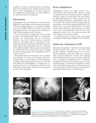 shoulder, the injected contrast medium may disclose
labral tears or defects in the capsular structures. In the
spine, contrast radiography can be used to diagnose
disc degeneration (discography) and abnormalities of
the small facet joints (facetography).
Myelography
Myelography was used extensively in the past for the
diagnosis of disc prolapse and other spinal canal lesions.
It has been largely replaced by non-invasive methods
such as CT and MRI. However, it still has a place in the
investigation of nerve root lesions and as an adjunct to
other methods in patients with back pain.
The oily media are no longer used, and even with
the ionic water-soluble iodides there is a considerable
incidence of complications, such as low-pressure
headache (due to the lumbar puncture), muscular
spasms or convulsions (due to neurotoxicity, espe-
cially if the chemical is allowed to ﬂow above the mid-
dorsal region) and arachnoiditis (which is attributed
to the hyperosmolality of these compounds in relation
to cerebrospinal ﬂuid). Precautions, such as keeping
the patient sitting upright after myelography, must be
strictly observed.
Metrizamide has low neurotoxicity and at working
concentrations it is more or less isotonic with cere-
brospinal ﬂuid. It can therefore be used throughout
the length of the spinal canal; the nerve roots are also
well delineated (radiculography). A bulging disc, an
intrathecal tumour or narrowing of the bony canal
will produce characteristic distortions of the opaque
column in the myelogram.
PLAIN TOMOGRAPHY
Tomography provides an image ‘focused’ on a
selected plane. By moving the tube and the x-ray ﬁlm
in opposite directions around the patient during the
exposure, images on either side of the pivotal plane
are deliberately blurred out. When several ‘cuts’ are
studied, lesions obscured in conventional x-rays may
be revealed. The method is useful for diagnosing seg-
mental bone necrosis and depressed fractures in can-
cellous bone (e.g. of the vertebral body or the tibial
plateau); these defects are often obscured in the plain
x-ray by the surrounding intact mass of bone. Small
radiolucent lesions, such as osteoid osteomas and
bone abscesses, can also be revealed.
A useful procedure in former years, conventional
tomography has been largely supplanted by CT and MRI.
COMPUTED TOMOGRAPHY (CT)
Like plain tomography, CT produces sectional images
through selected tissue planes – but with much
greater resolution. A further advance over conven-
tional tomography is that the images are trans-axial
(like transverse anatomical sections), thus exposing
anatomical planes that are never viewed in plain ﬁlm
x-rays. A general (or ‘localization’) view is obtained,
the region of interest is selected and a series of cross-
sectional images is produced and digitally recorded.
‘Slices’ through the larger joints or tissue masses may
be 5–10 mm apart; those through the small joints or
intervertebral discs have to be much thinner.
GENERALORTHOPAEDICS
20
1
1.18 Computed tomography (CT) The plain x-ray (a) shows a fracture of the vertebral
body but one cannot tell precisely how the bone fragments are displaced. The CT (b) shows
clearly that they are dangerously close to the cauda equina. (c) Congenital hip dislocation,
deﬁned more clearly by (d) three-dimensional CT reconstruction.
(c) (d)
(a)
(b)
 