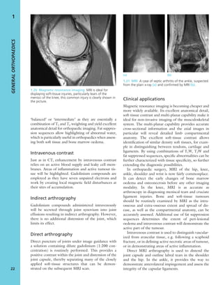 ‘balanced’ or ‘intermediate’ as they are essentially a
combination of T1 and T2 weighting and yield excellent
anatomical detail for orthopaedic imaging. Fat suppres-
sion sequences allow highlighting of abnormal water,
which is particularly useful in orthopaedics when assess-
ing both soft tissue and bone marrow oedema.
Intravenous contrast
Just as in CT, enhancement by intravenous contrast
relies on an active blood supply and leaky cell mem-
branes. Areas of inﬂammation and active tumour tis-
sue will be highlighted. Gadolinium compounds are
employed as they have seven unpaired electrons and
work by creating local magnetic ﬁeld disturbances at
their sites of accumulation.
Indirect arthrography
Gadolinium compounds administered intravenously
will be secreted through joint synovium into joint
effusions resulting in indirect arthrography. However,
there is no additional distension of the joint, which
limits its effect.
Direct arthrography
Direct puncture of joints under image guidance with
a solution containing dilute gadolinium (1:200 con-
centration) is routinely performed. This provides a
positive contrast within the joint and distension of the
joint capsule, thereby separating many of the closely
applied soft-tissue structures that can be demon-
strated on the subsequent MRI scan.
Clinical applications
Magnetic resonance imaging is becoming cheaper and
more widely available. Its excellent anatomical detail,
soft-tissue contrast and multi-planar capability make it
ideal for non-invasive imaging of the musculoskeletal
system. The multi-planar capability provides accurate
cross-sectional information and the axial images in
particular will reveal detailed limb compartmental
anatomy. The excellent soft-tissue contrast allows
identiﬁcation of similar density soft tissues, for exam-
ple in distinguishing between tendons, cartilage and
ligaments. By using combinations of T1W, T2W and
fat suppressed sequences, speciﬁc abnormalities can be
further characterized with tissue speciﬁcity, so further
extending the diagnostic possibilities.
In orthopaedic surgery, MRI of the hip, knee,
ankle, shoulder and wrist is now fairly commonplace.
It can detect the early changes of bone marrow
oedema and osteonecrosis before any other imaging
modality. In the knee, MRI is as accurate as
arthroscopy in diagnosing meniscal tears and cruciate
ligament injuries. Bone and soft-tissue tumours
should be routinely examined by MRI as the intra-
osseous and extra-osseous extent and spread of dis-
ease, as well as the compartmental anatomy, can be
accurately assessed. Additional use of fat suppression
sequences determines the extent of peri-lesional
oedema and intravenous contrast will demonstrate the
active part of the tumour.
Intravenous contrast is used to distinguish vascular-
ized from avascular tissue, e.g. following a scaphoid
fracture, or in deﬁning active necrotic areas of tumour,
or in demonstrating areas of active inﬂammation.
Direct MRI arthrography is used to distend the
joint capsule and outline labral tears in the shoulder
and the hip. In the ankle, it provides the way to
demonstrate anterolateral impingement and assess the
integrity of the capsular ligaments.
GENERALORTHOPAEDICS
22
1
1.20 Magnetic resonance imaging MRI is ideal for
displaying soft-tissue injuries, particularly tears of the
menisci of the knee; this common injury is clearly shown in
the picture.
(a) (b)
1.21 MRI A case of septic arthritis of the ankle, suspected
from the plain x-ray (a) and conﬁrmed by MRI (b).
 