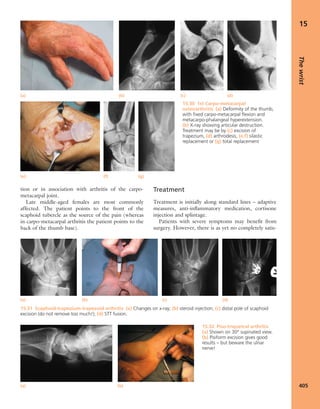 Apley's shoulderjt examination