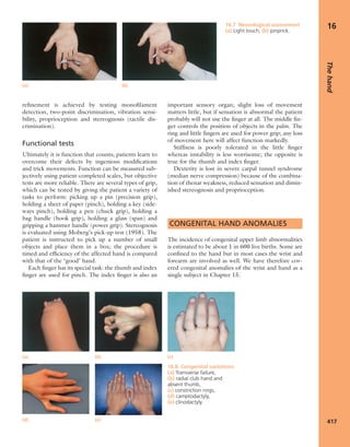 Apley's shoulderjt examination