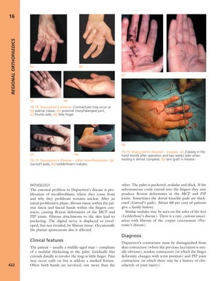 Apley's shoulderjt examination