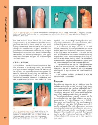 Apley's shoulderjt examination