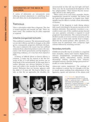 Apley's shoulderjt examination