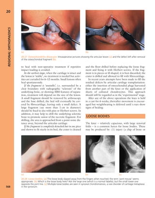 Apley's shoulderjt examination