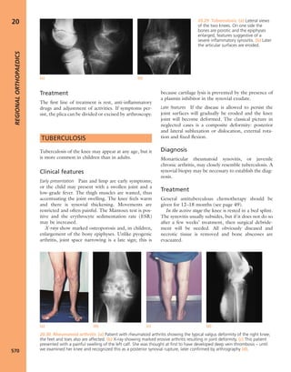 Apley's shoulderjt examination