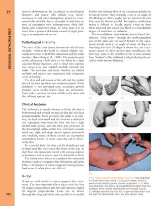 Apley's shoulderjt examination