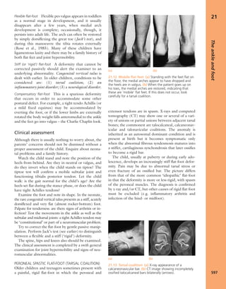 Apley's shoulderjt examination