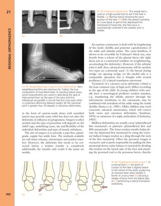 Apley's shoulderjt examination