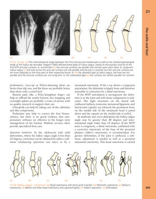Apley's shoulderjt examination