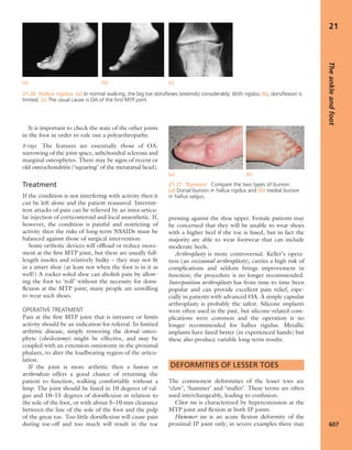 Apley's shoulderjt examination