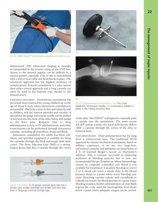 Apley's shoulderjt examination