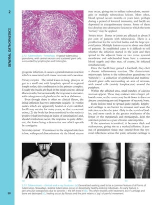 pyogenic infection, it causes a granulomatous reaction
which is associated with tissue necrosis and caseation.
Primary complex The initial lesion in lung, pharynx or
gut is a small one with lymphatic spread to regional
lymph nodes; this combination is the primary complex.
Usually the bacilli are ﬁxed in the nodes and no clinical
illness results, but occasionally the response is excessive,
with enlargement of glands in the neck or abdomen.
Even though there is often no clinical illness, the
initial infection has two important sequels: (1) within
nodes which are apparently healed or even calciﬁed,
bacilli may survive for many years, so that a reservoir
exists; (2) the body has been sensitized to the toxin (a
positive Heaf test being an index of sensitization) and,
should reinfection occur, the response is quite differ-
ent, the lesion being a destructive one which spreads
by contiguity.
Secondary spread If resistance to the original infection
is low, widespread dissemination via the blood stream
may occur, giving rise to miliary tuberculosis, menin-
gitis or multiple tuberculous lesions. More often,
blood spread occurs months or years later, perhaps
during a period of lowered immunity, and bacilli are
deposited in extrapulmonary tissues. Some of these
foci develop into destructive lesions to which the term
‘tertiary’ may be applied.
Tertiary lesion Bones or joints are affected in about 5
per cent of patients with tuberculosis. There is a
predilection for the vertebral bodies and the large syn-
ovial joints. Multiple lesions occur in about one-third
of patients. In established cases it is difﬁcult to tell
whether the infection started in the joint and then
spread to the adjacent bone or vice versa; synovial
membrane and subchondral bone have a common
blood supply and they may, of course, be infected
simultaneously.
Once the bacilli have gained a foothold, they elicit
a chronic inﬂammatory reaction. The characteristic
microscopic lesion is the tuberculous granuloma (or
‘tubercle’) – a collection of epithelioid and multinu-
cleated giant cells surrounding an area of necrosis,
with round cells (mainly lymphocytes) around the
periphery.
Within the affected area, small patches of caseous
necrosis appear. These may coalesce into a larger yel-
lowish mass, or the centre may break down to form an
abscess containing pus and fragments of necrotic bone.
Bone lesions tend to spread quite rapidly. Epiphy-
seal cartilage is no barrier to invasion and soon the
infection reaches the joint. Only in the vertebral bod-
ies, and more rarely in the greater trochanter of the
femur or the metatarsals and metacarpals, does the
infection persist as a pure chronic osteomyelitis.
If the synovium is involved, it becomes thick and
oedematous, giving rise to a marked effusion. A pan-
nus of granulation tissue may extend from the syn-
ovial reﬂections across the joint; articular cartilage is
GENERALORTHOPAEDICS
50
2
2.12 Tuberculosis – histology A typical tuberculous
granuloma, with central necrosis and scattered giant cells
surrounded by lymphocytes and histiocytes.
(a) (b) (c)
2.13 Tuberculosis – clinical and x-ray features (a) Generalized wasting used to be a common feature of all forms of
tuberculosis. Nowadays, skeletal tuberculosis occurs in deceptively healthy-looking individuals. An early feature is
peri-articular osteoporosis due to synovitis – the left knee in (b). This often resolves with treatment, but if cartilage and
bone are destroyed (c), healing occurs by ﬁbrosis and the joint retains a ‘jog’ of painful movement.
 